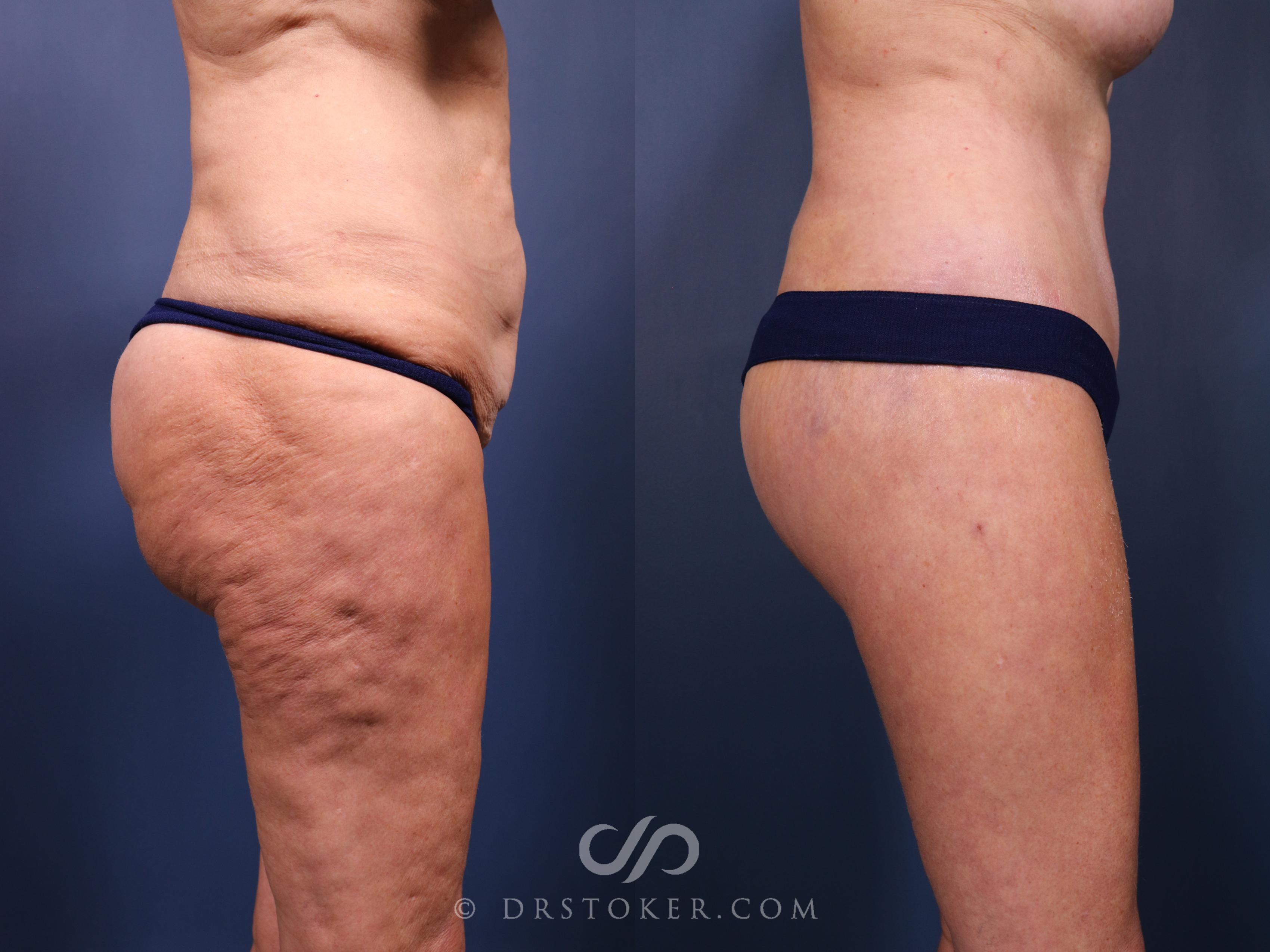 Before & After Bikini Body Lift Case 2392 Right Side View in Los Angeles, CA