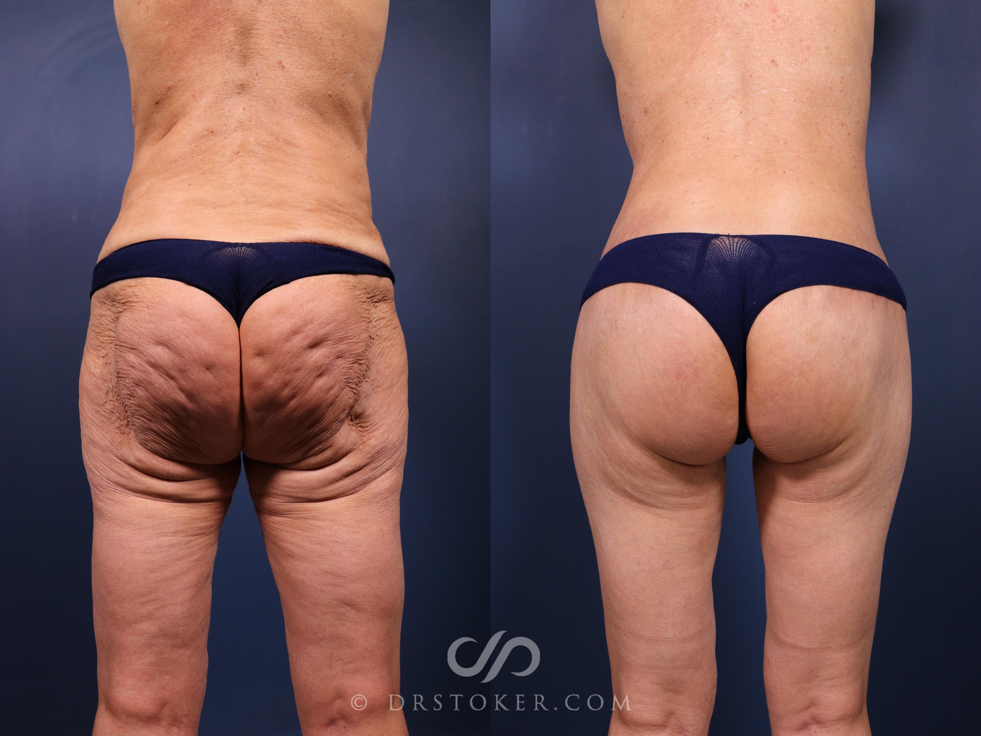 Before & After Bikini Body Lift Case 2393 Back View in Los Angeles, CA