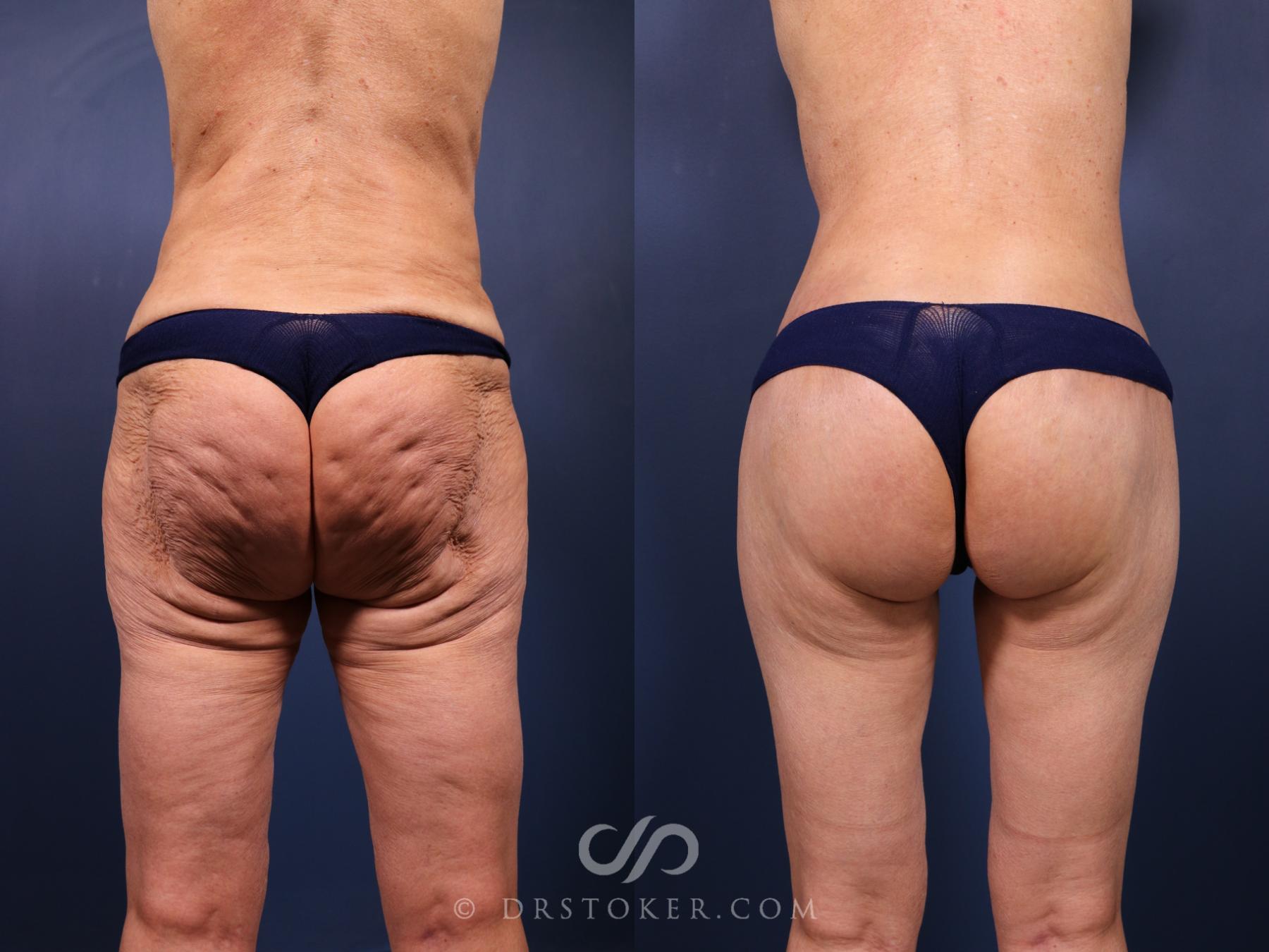 Before & After Bikini Body Lift Case 2393 Back View in Los Angeles, CA