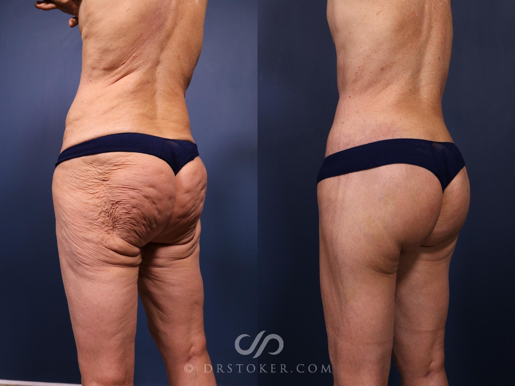Before & After Bikini Body Lift Case 2393 Left Oblique View in Los Angeles, CA