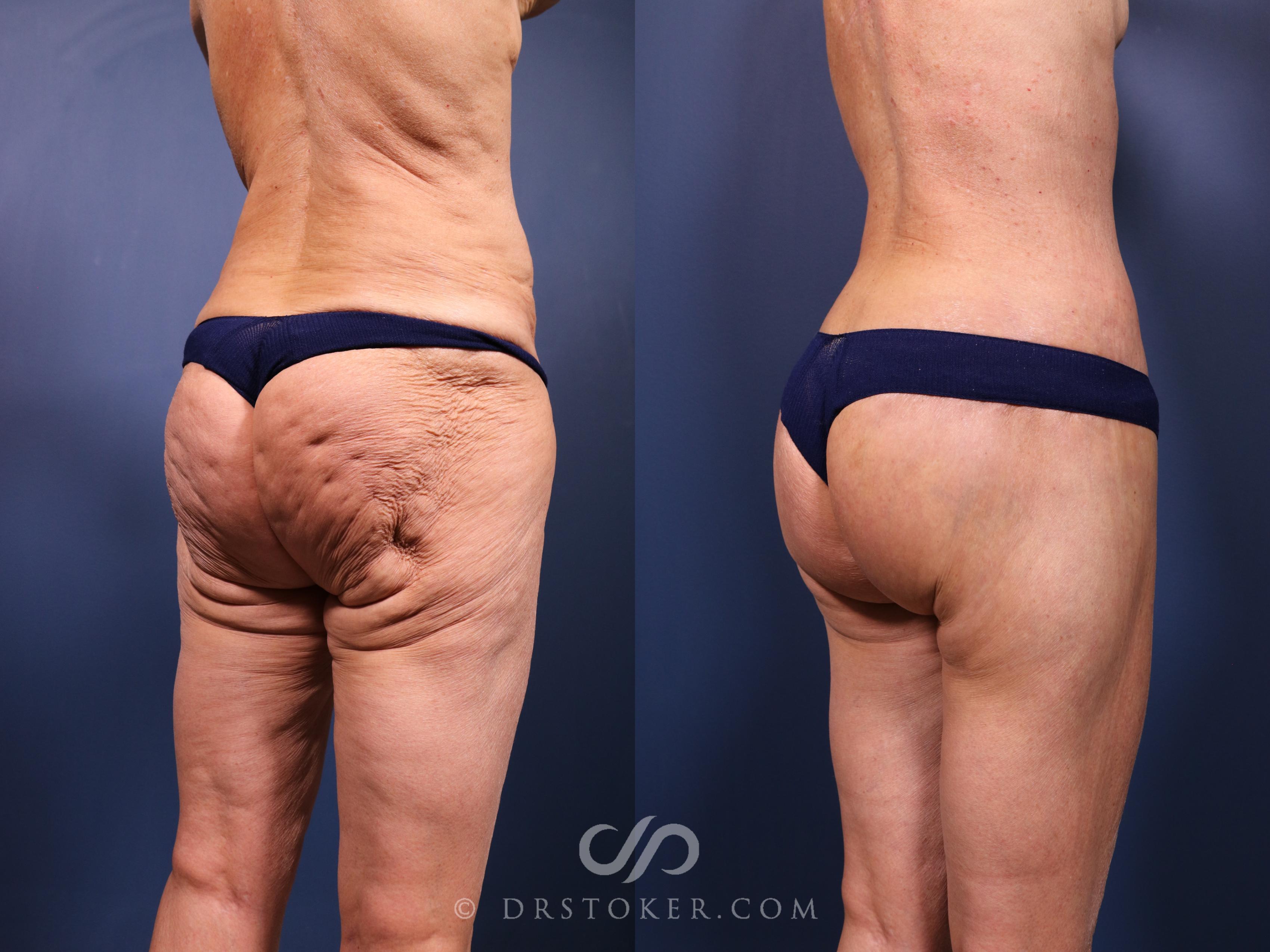 Before & After Bikini Body Lift Case 2393 Right Oblique View in Los Angeles, CA