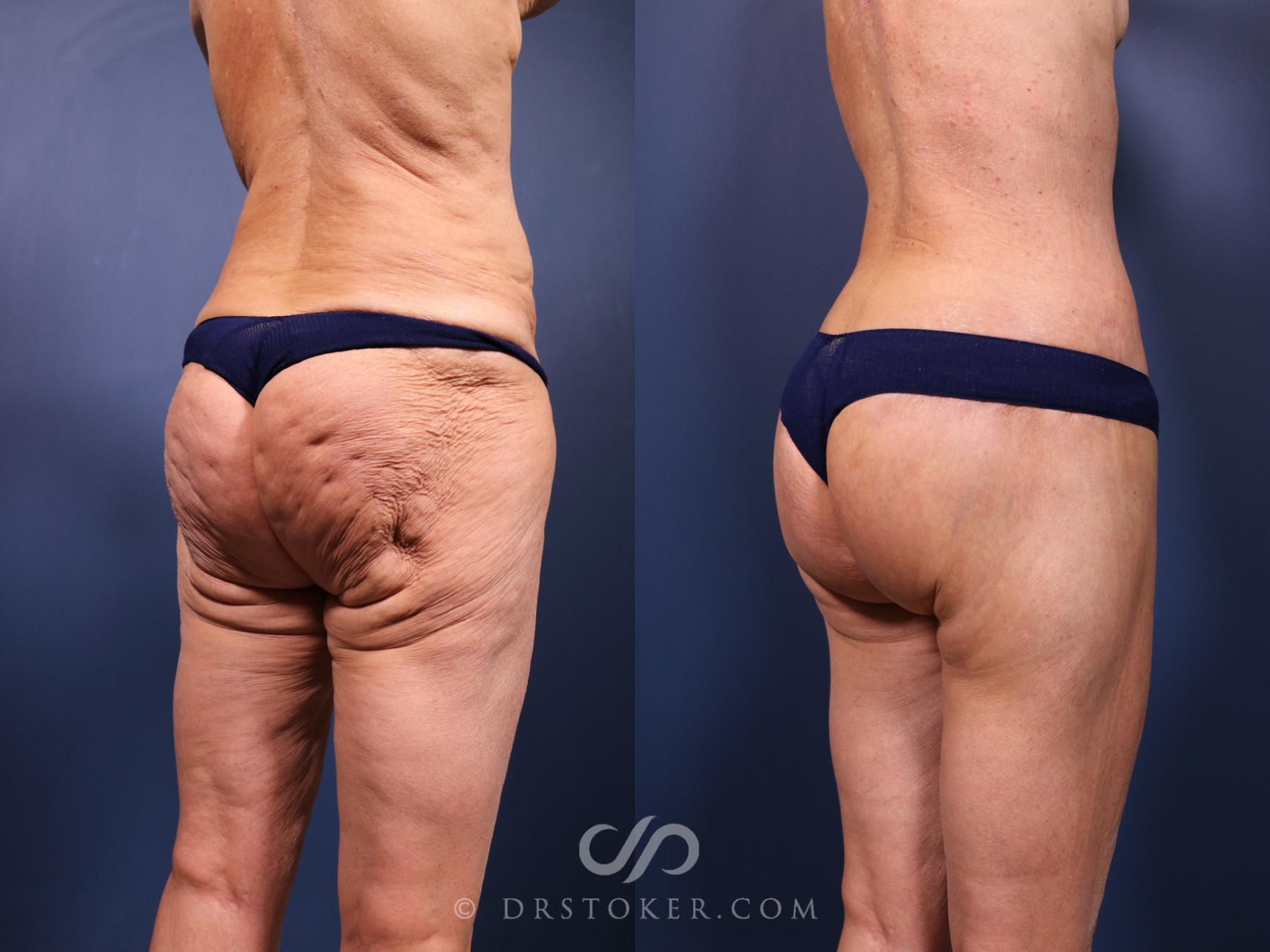 Before & After Bikini Body Lift Case 2393 Right Oblique View in Los Angeles, CA