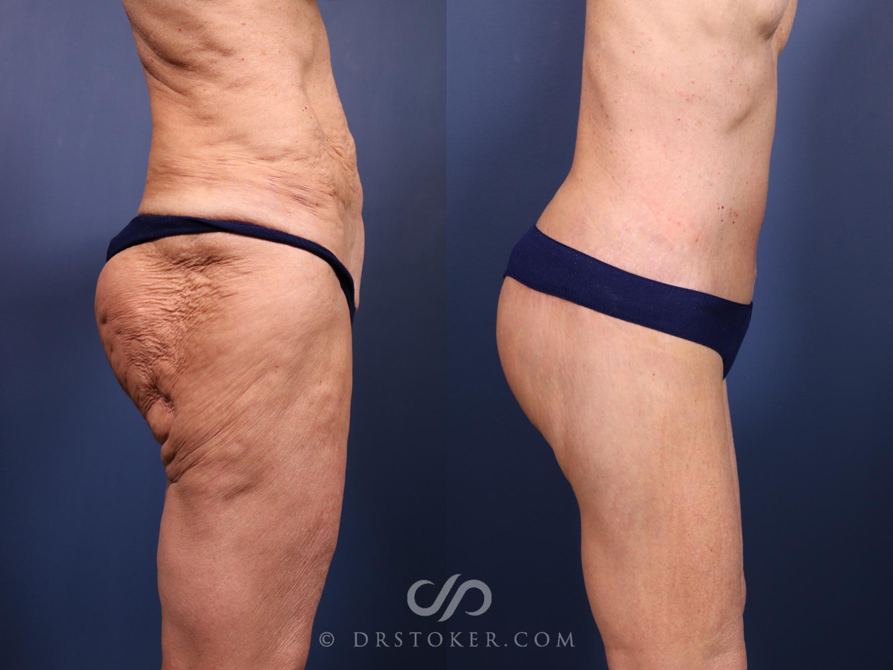 Before & After Bikini Body Lift Case 2393 Right Side View in Los Angeles, CA