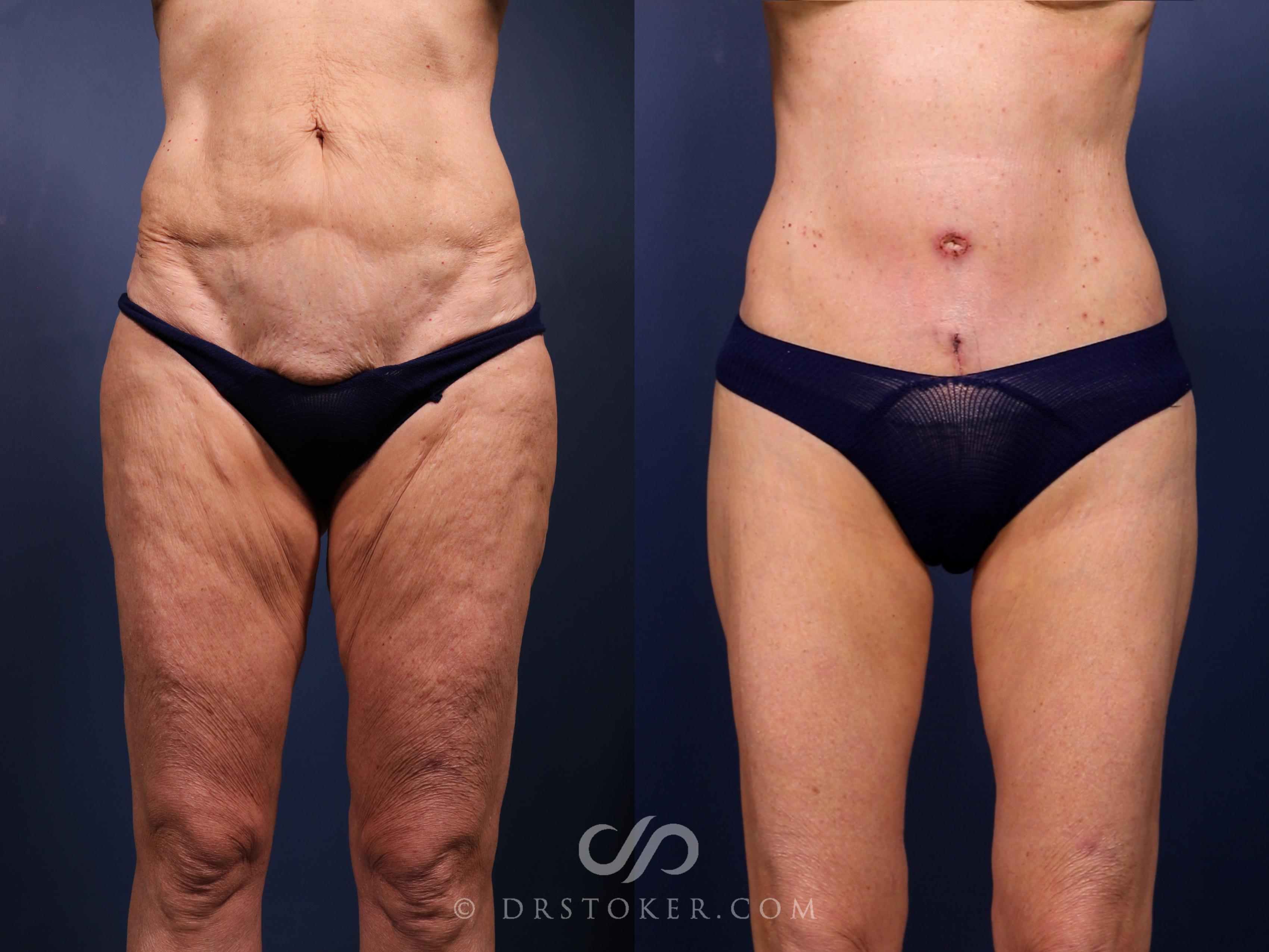 Before & After Bikini Body Lift Case 2394 Front View in Los Angeles, CA