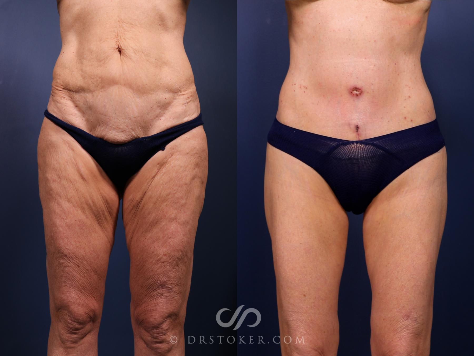 Before & After Bikini Body Lift Case 2394 Front View in Los Angeles, CA