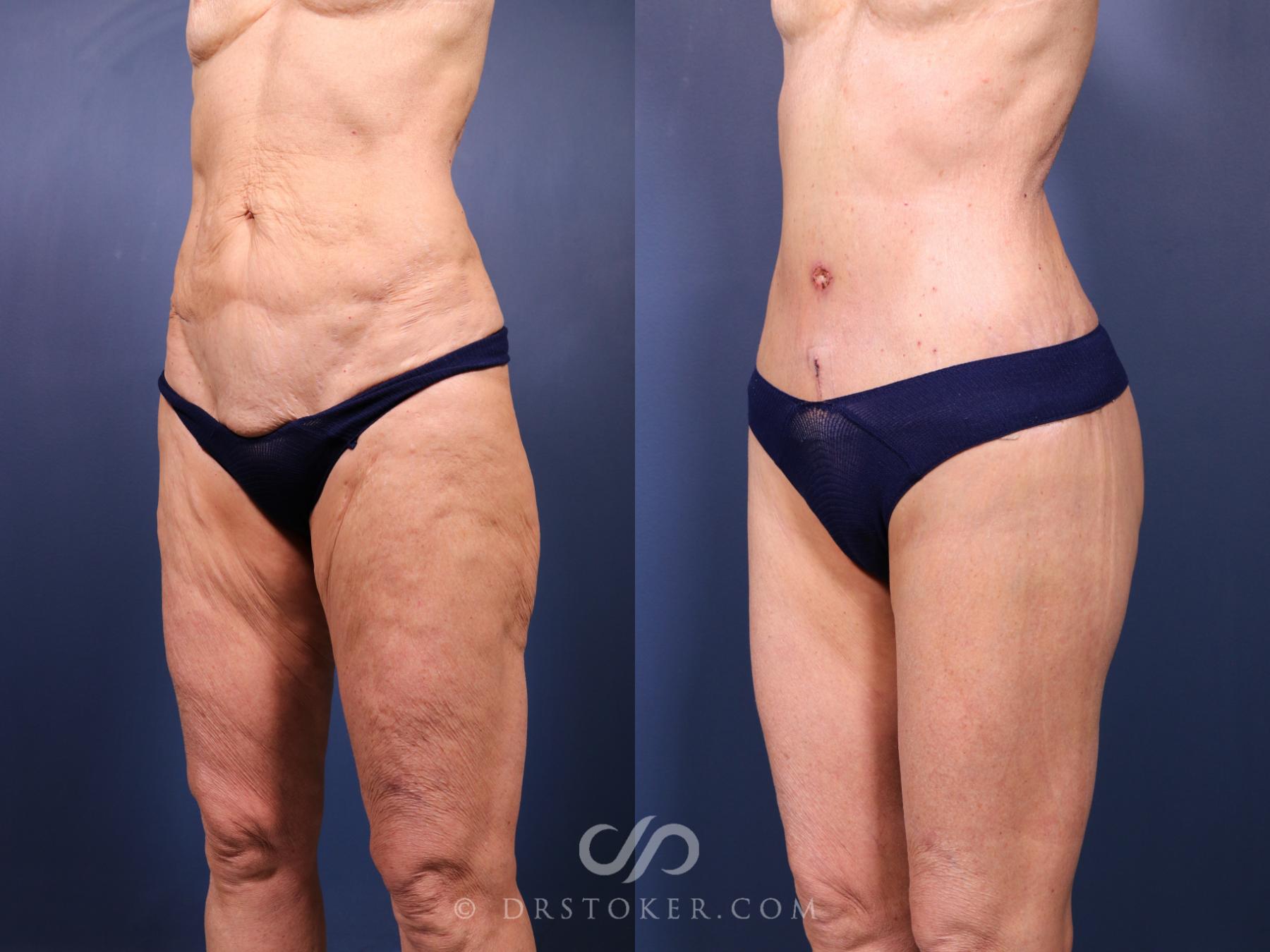Before & After Bikini Body Lift Case 2394 Left Oblique View in Los Angeles, CA