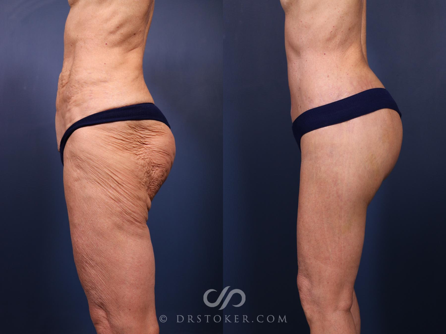 Before & After Bikini Body Lift Case 2394 Left Side View in Los Angeles, CA