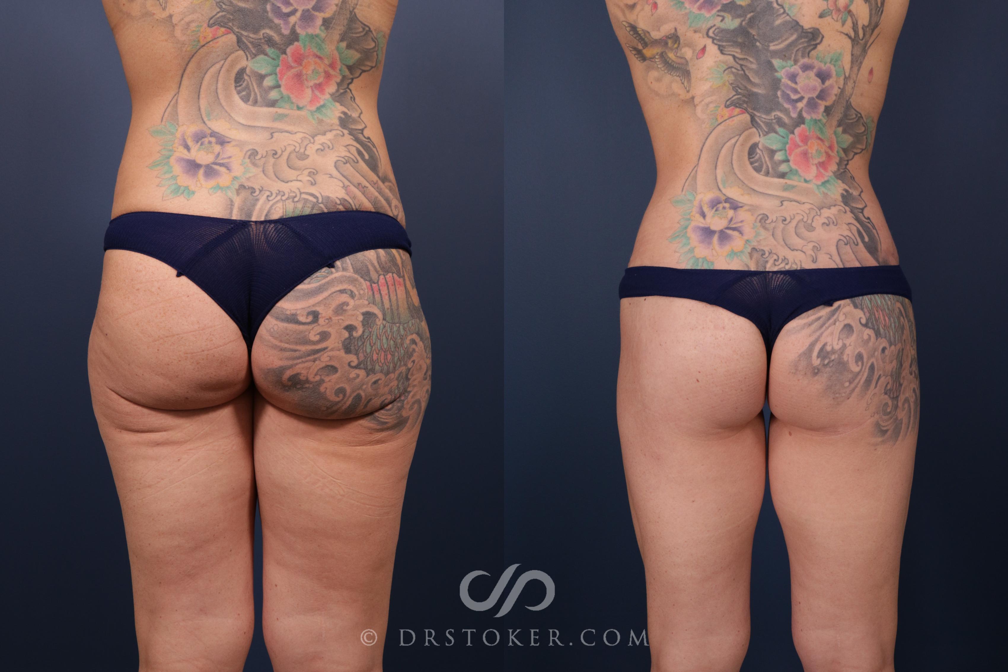 Before & After Bikini Body Lift Case 2395 Back View in Los Angeles, CA