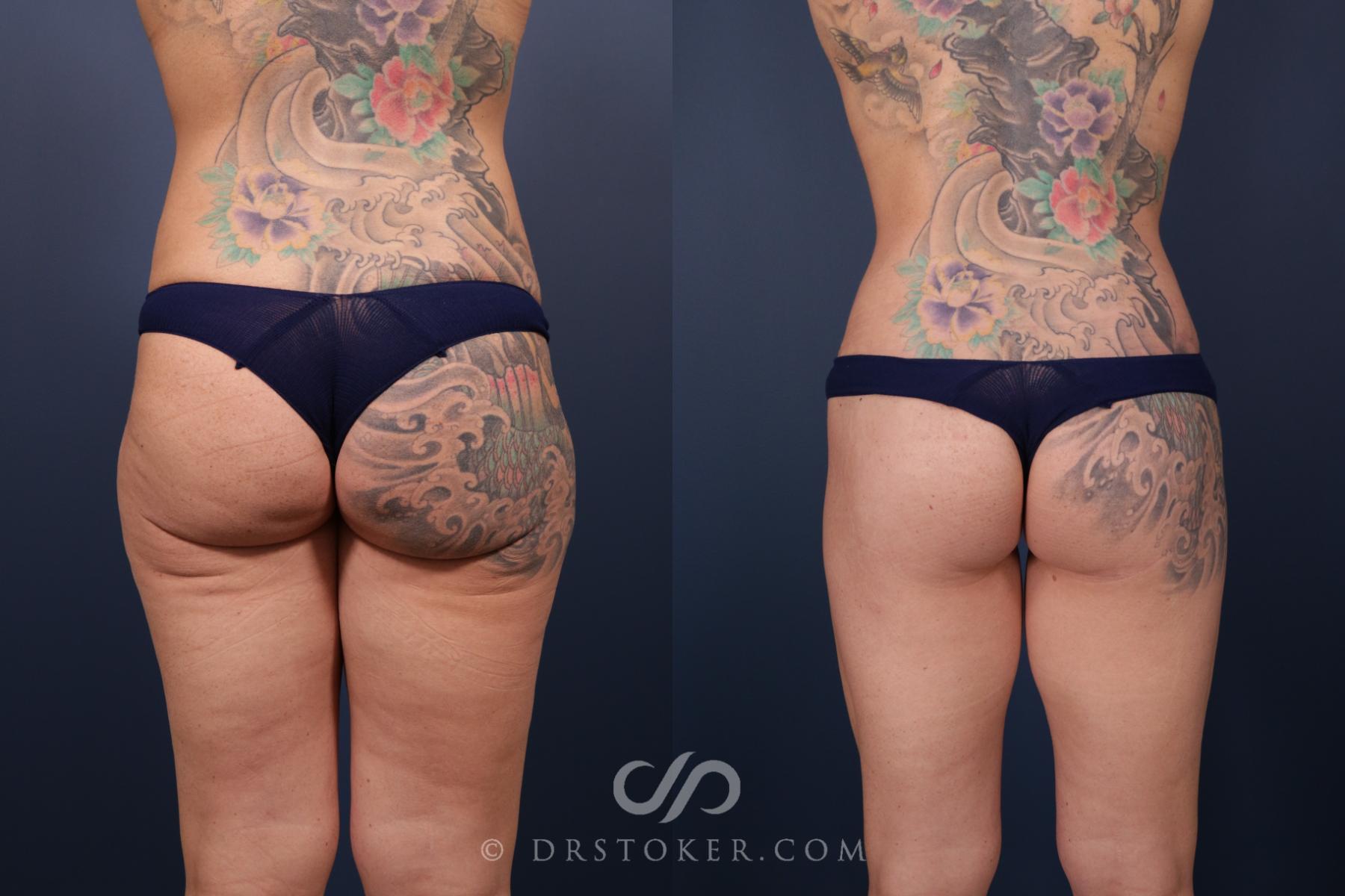 Before & After Bikini Body Lift Case 2395 Back View in Los Angeles, CA