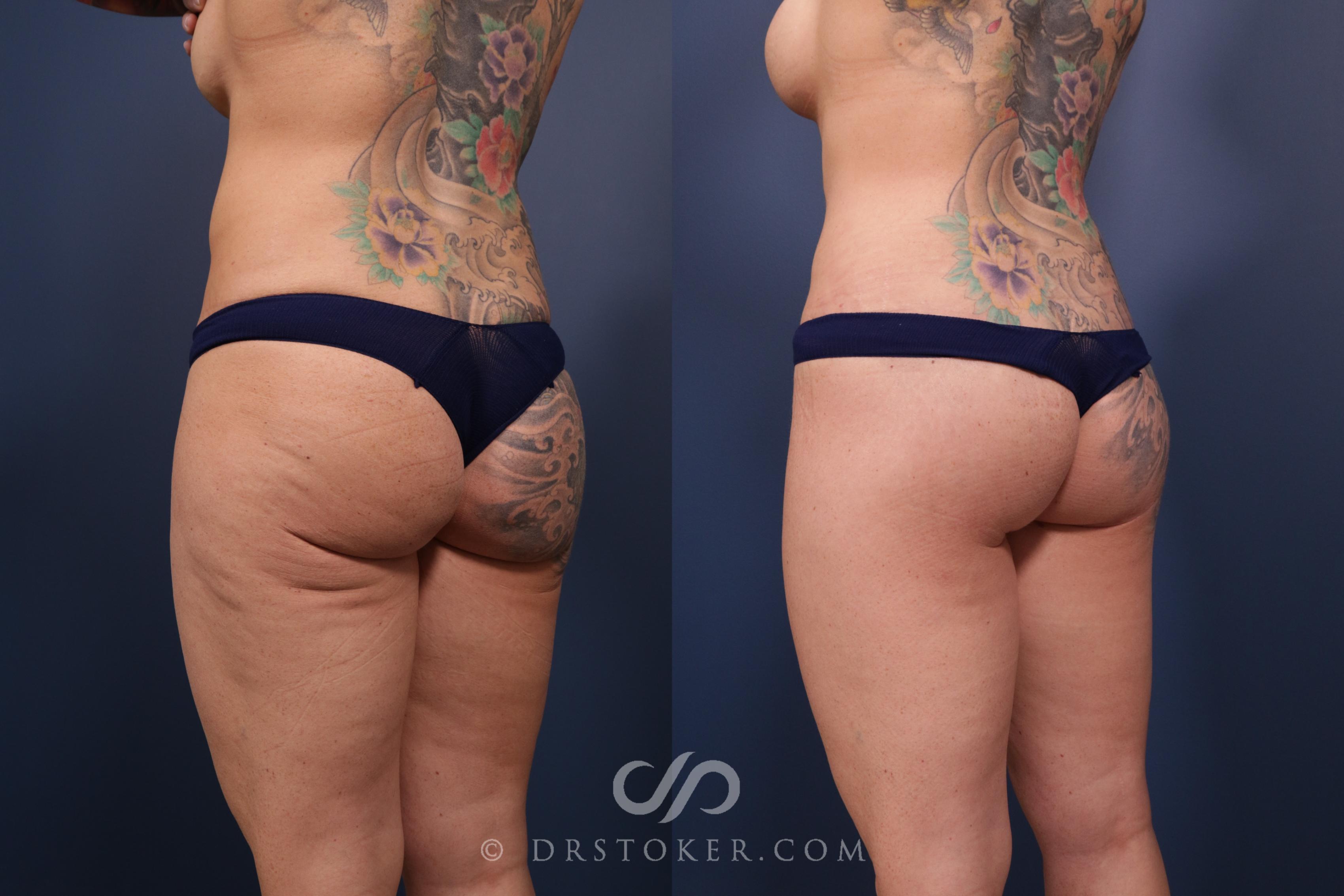 Before & After Bikini Body Lift Case 2395 Left Oblique View in Los Angeles, CA