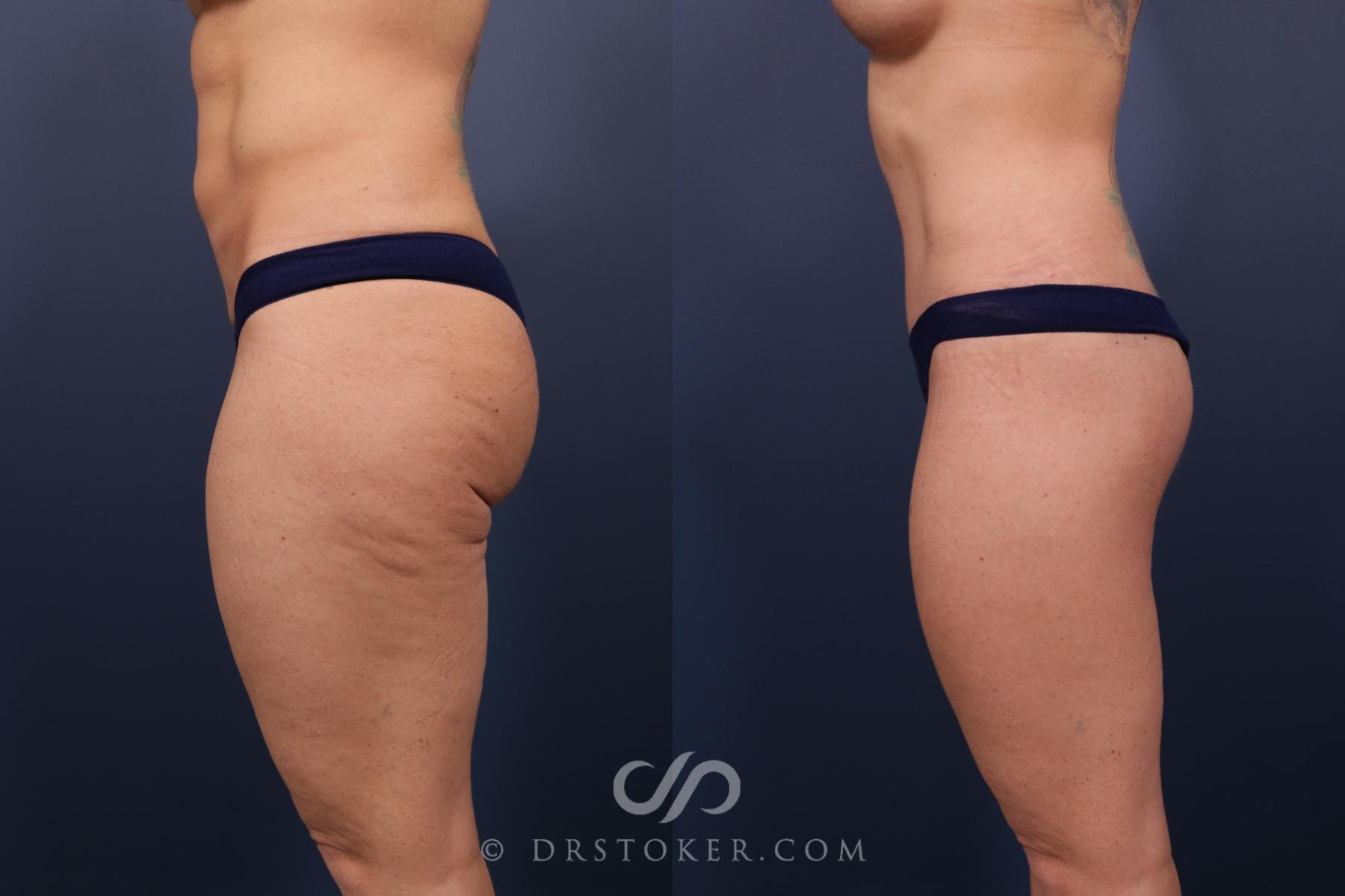Before & After Bikini Body Lift Case 2395 Left Side View in Los Angeles, CA