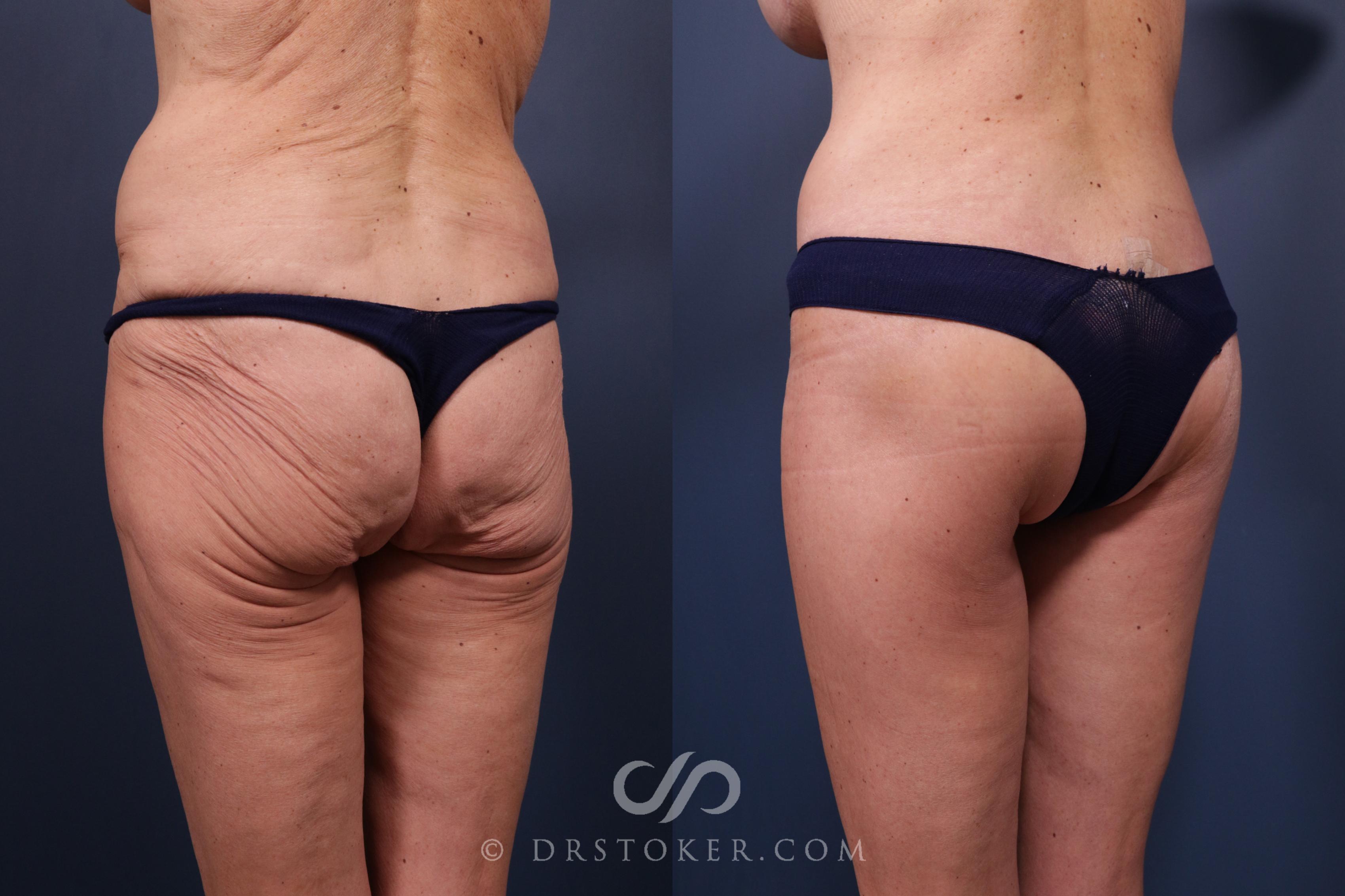Before & After Bikini Body Lift Case 2396 Left Oblique View in Los Angeles, CA