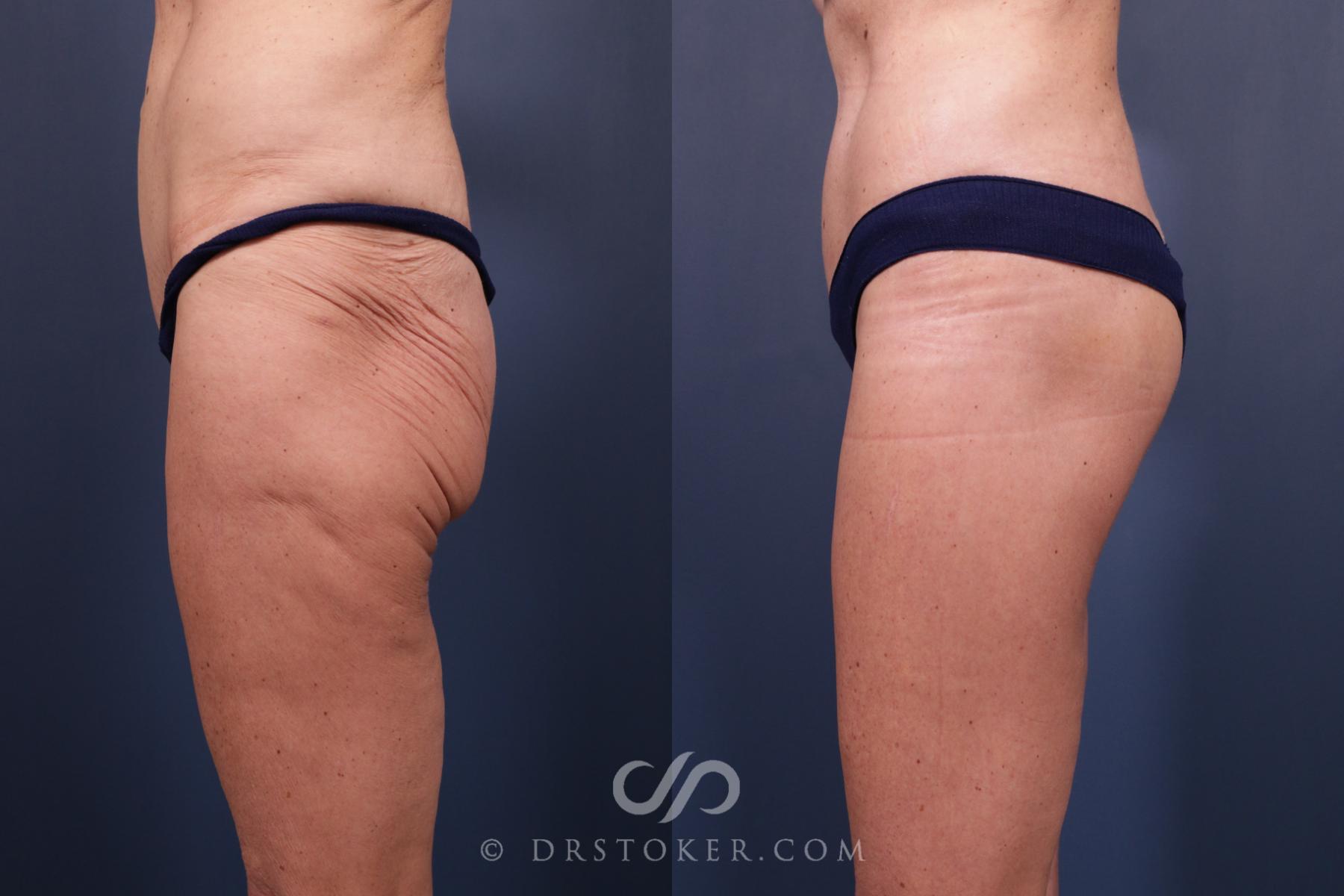 Before & After Bikini Body Lift Case 2396 Left Side View in Los Angeles, CA