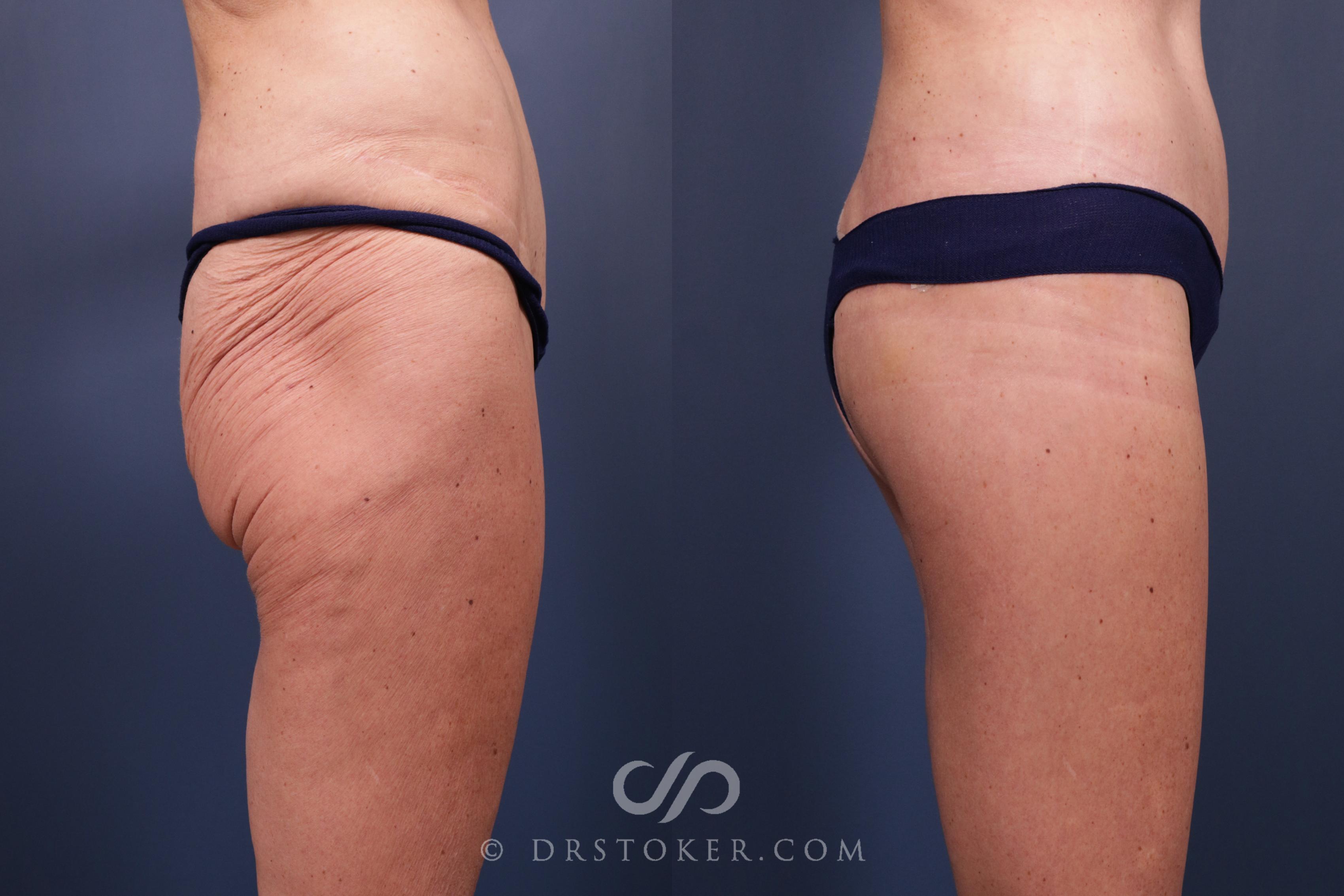 Before & After Bikini Body Lift Case 2396 Right Side View in Los Angeles, CA