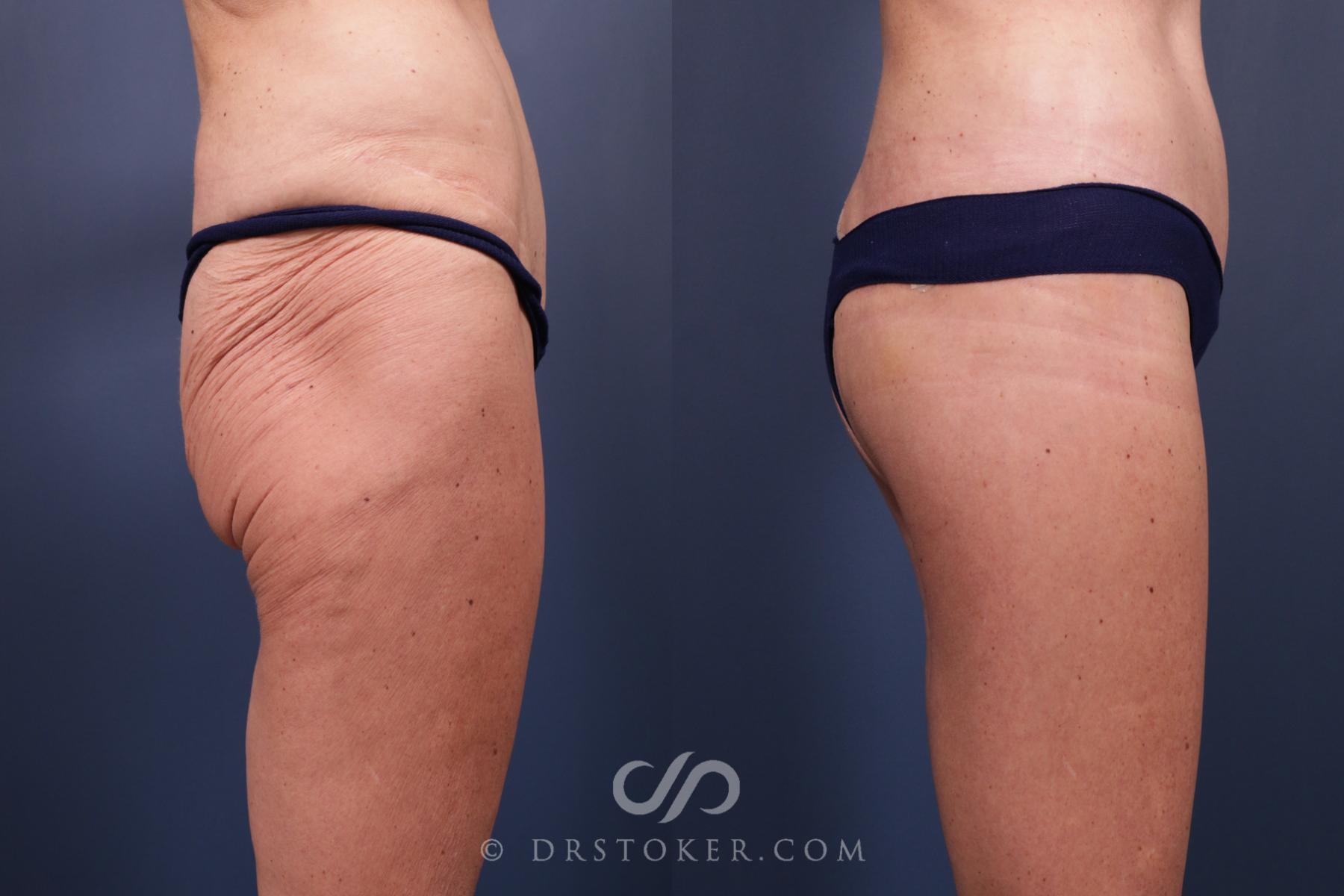 Before & After Bikini Body Lift Case 2396 Right Side View in Los Angeles, CA