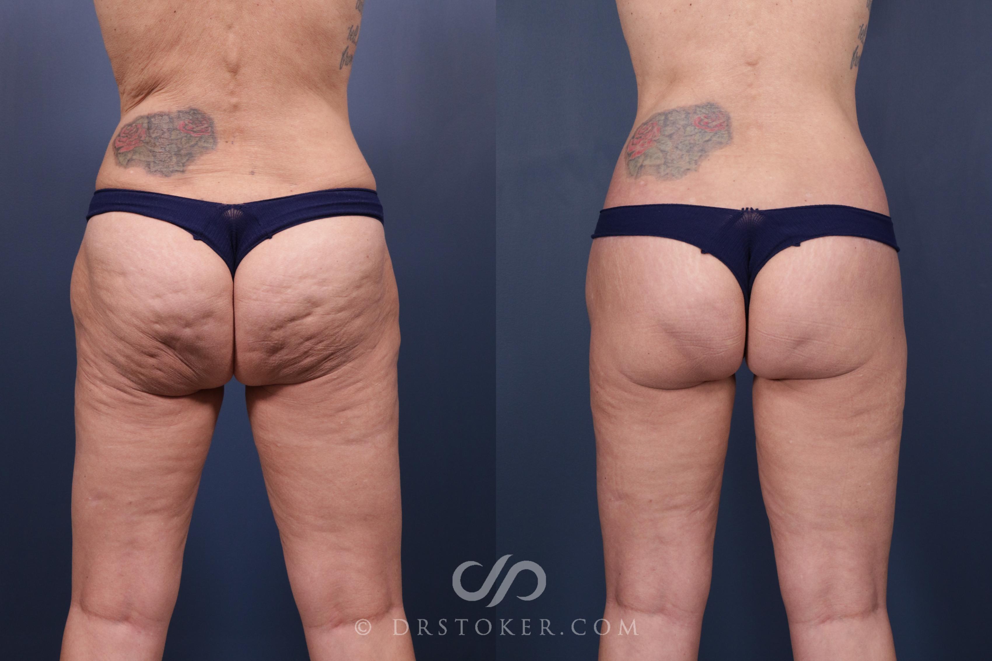 Before & After Bikini Body Lift Case 2397 Back View in Los Angeles, CA