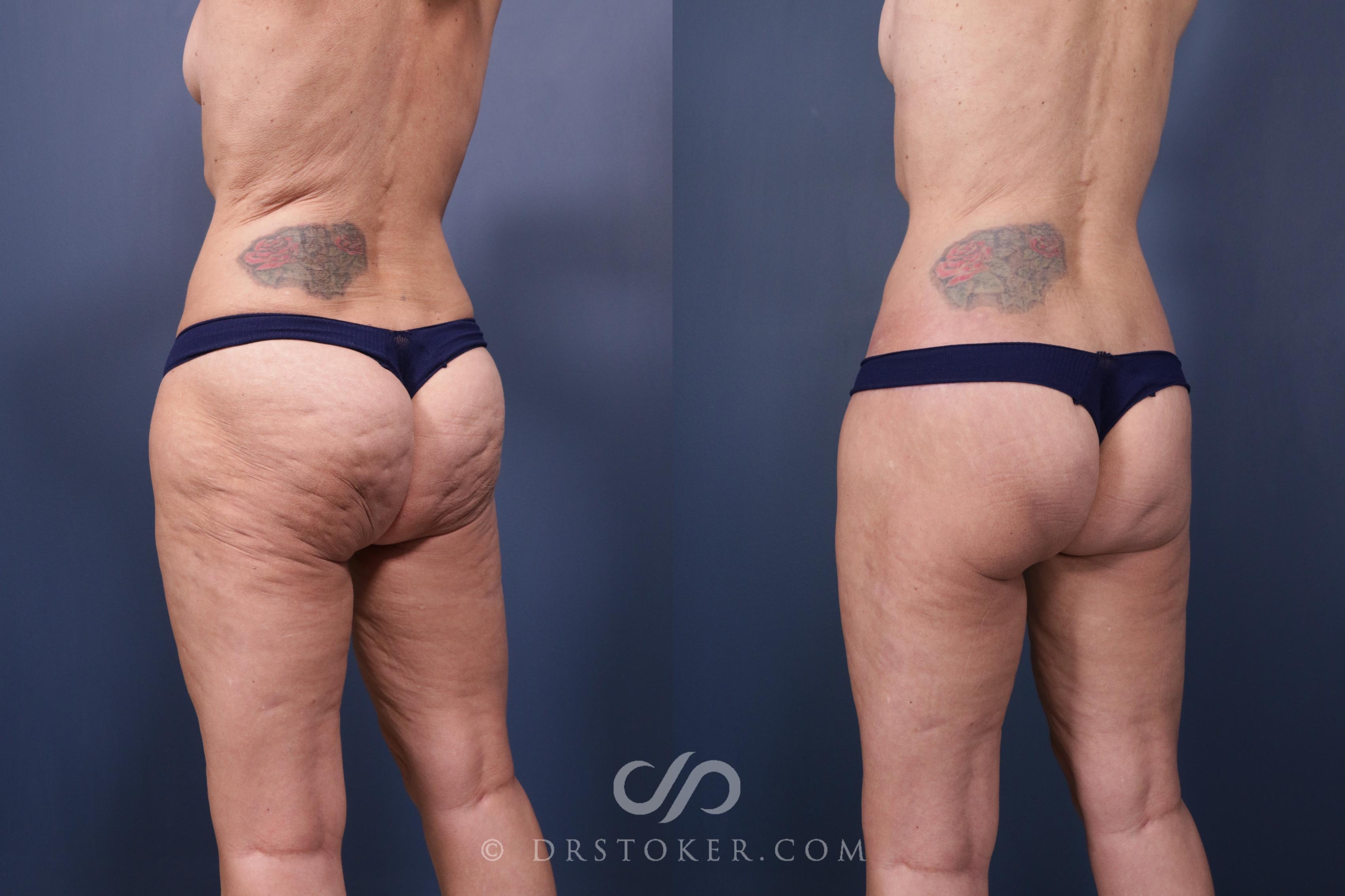 Before & After Bikini Body Lift Case 2397 Left Oblique View in Los Angeles, CA