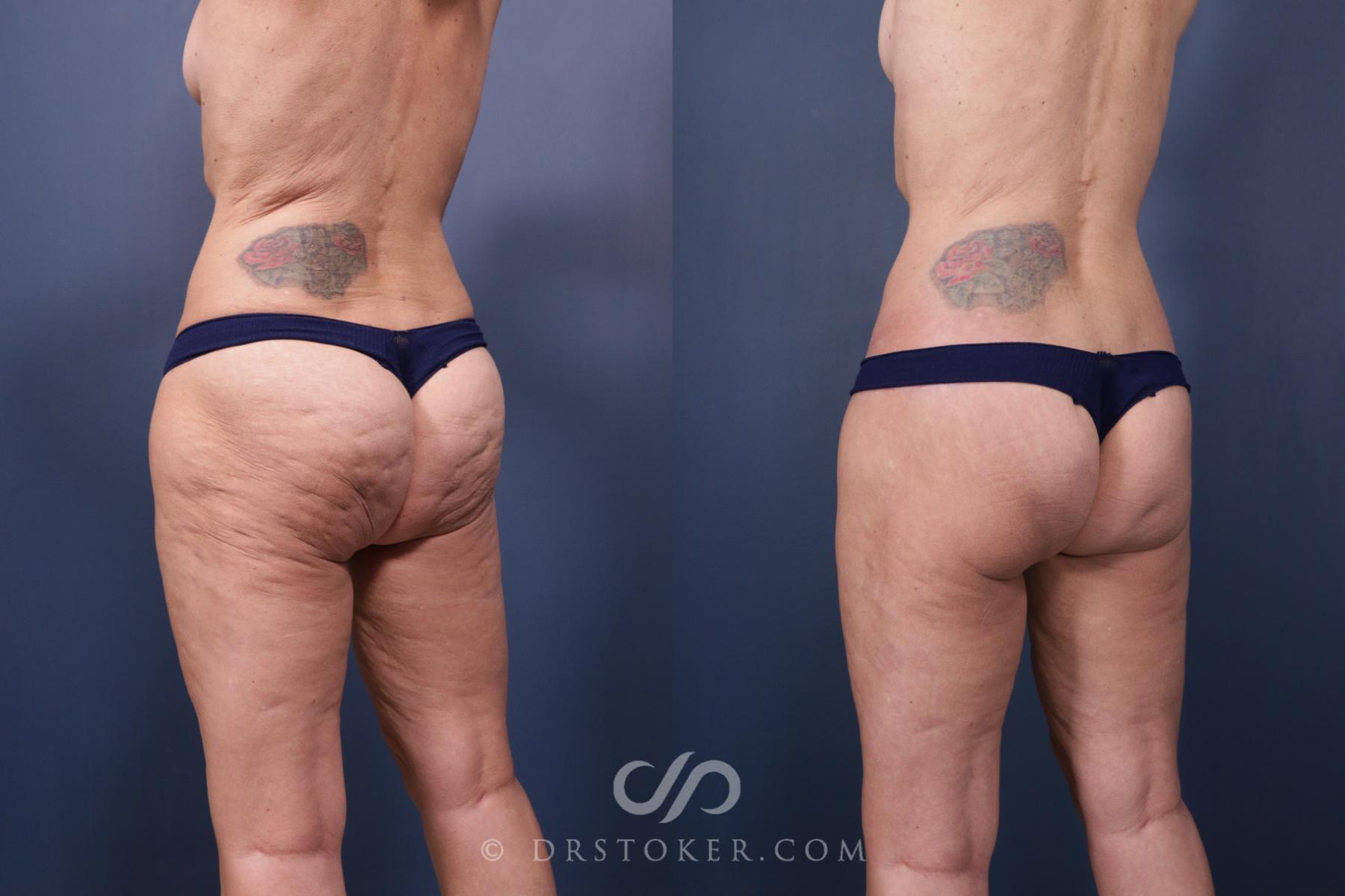 Before & After Bikini Body Lift Case 2397 Left Oblique View in Los Angeles, CA