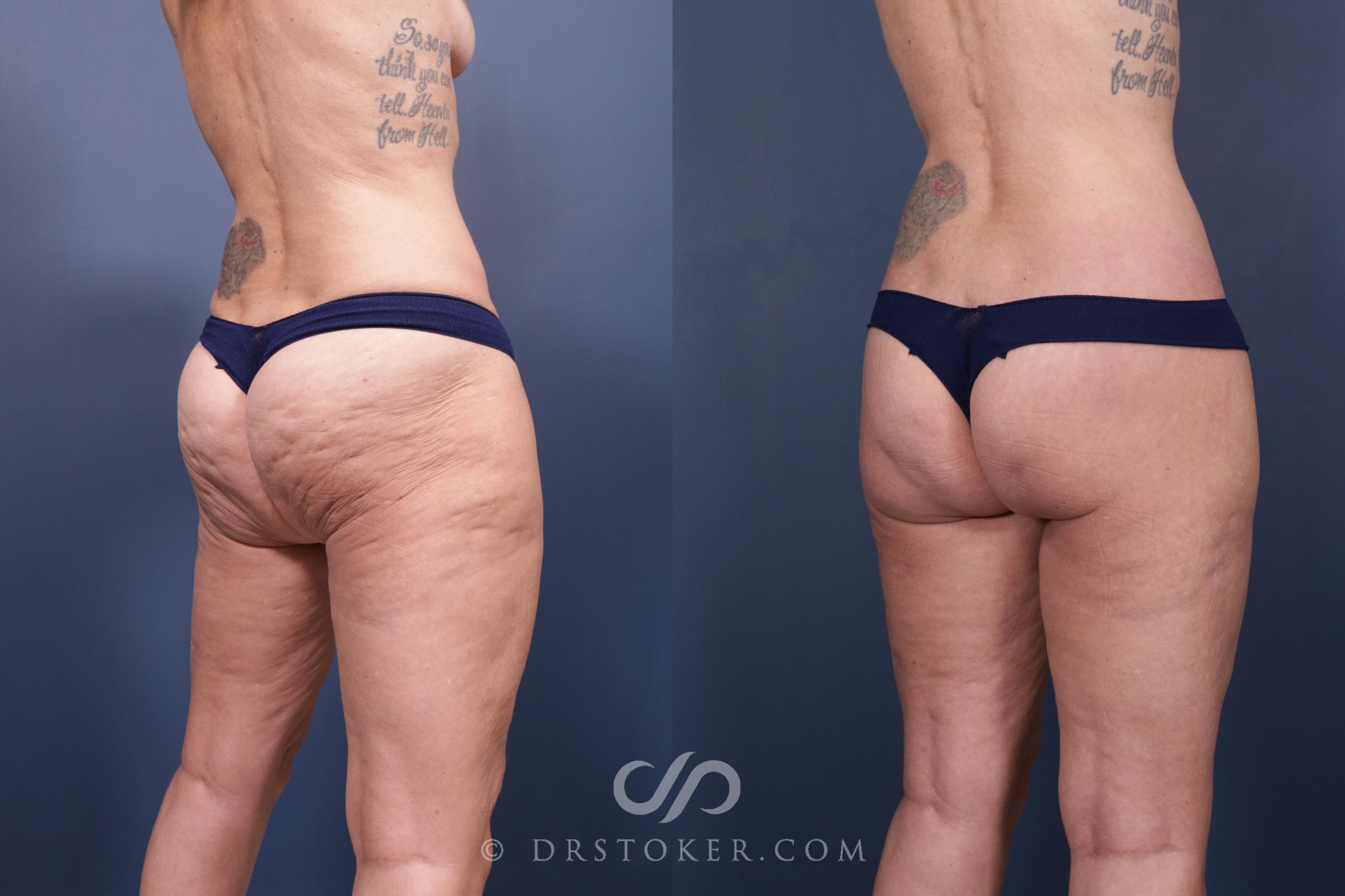 Before & After Bikini Body Lift Case 2397 Right Oblique View in Los Angeles, CA