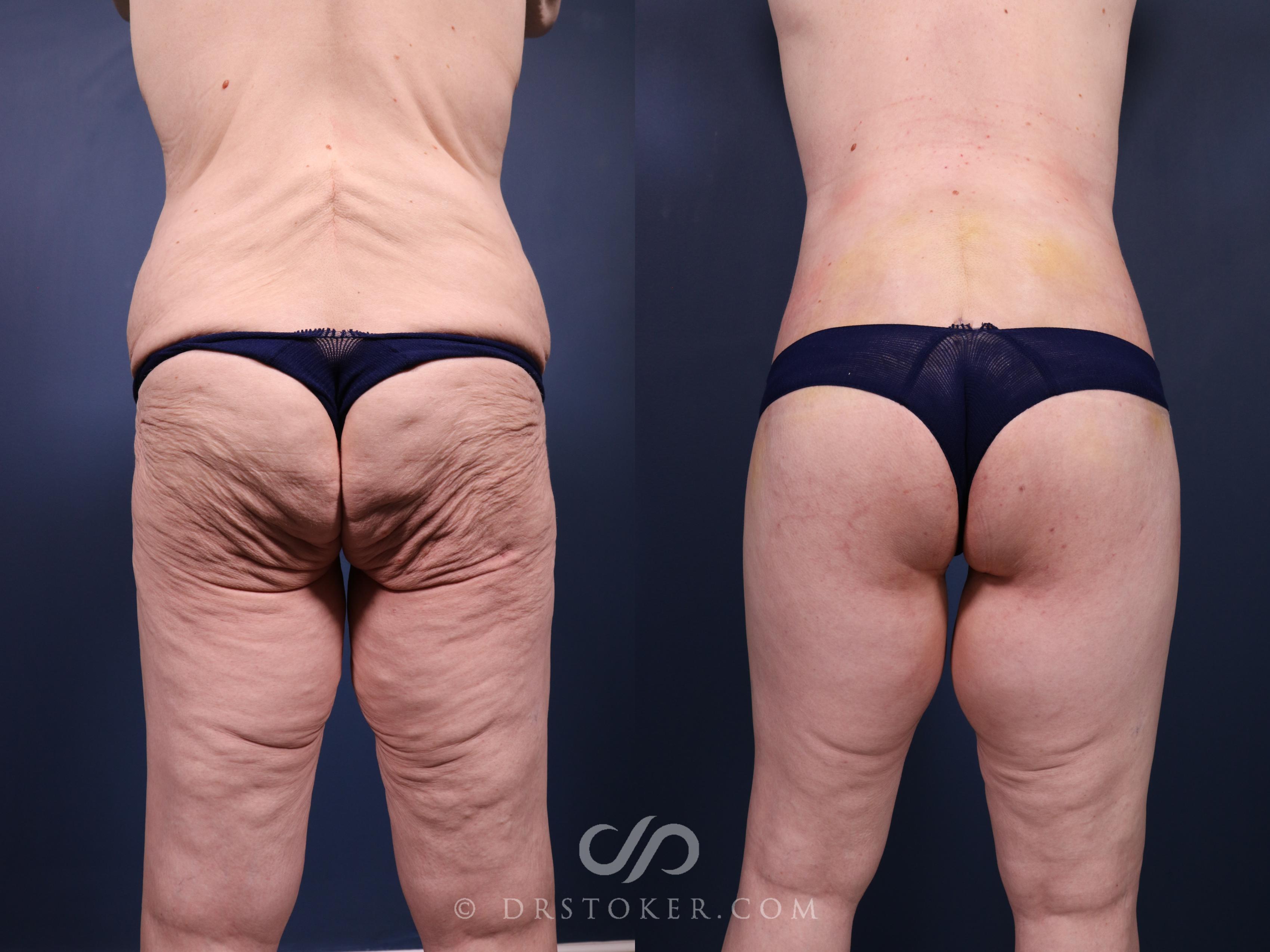 Before & After Buttock Lift (Excisional) Case 2398 Back View in Los Angeles, CA