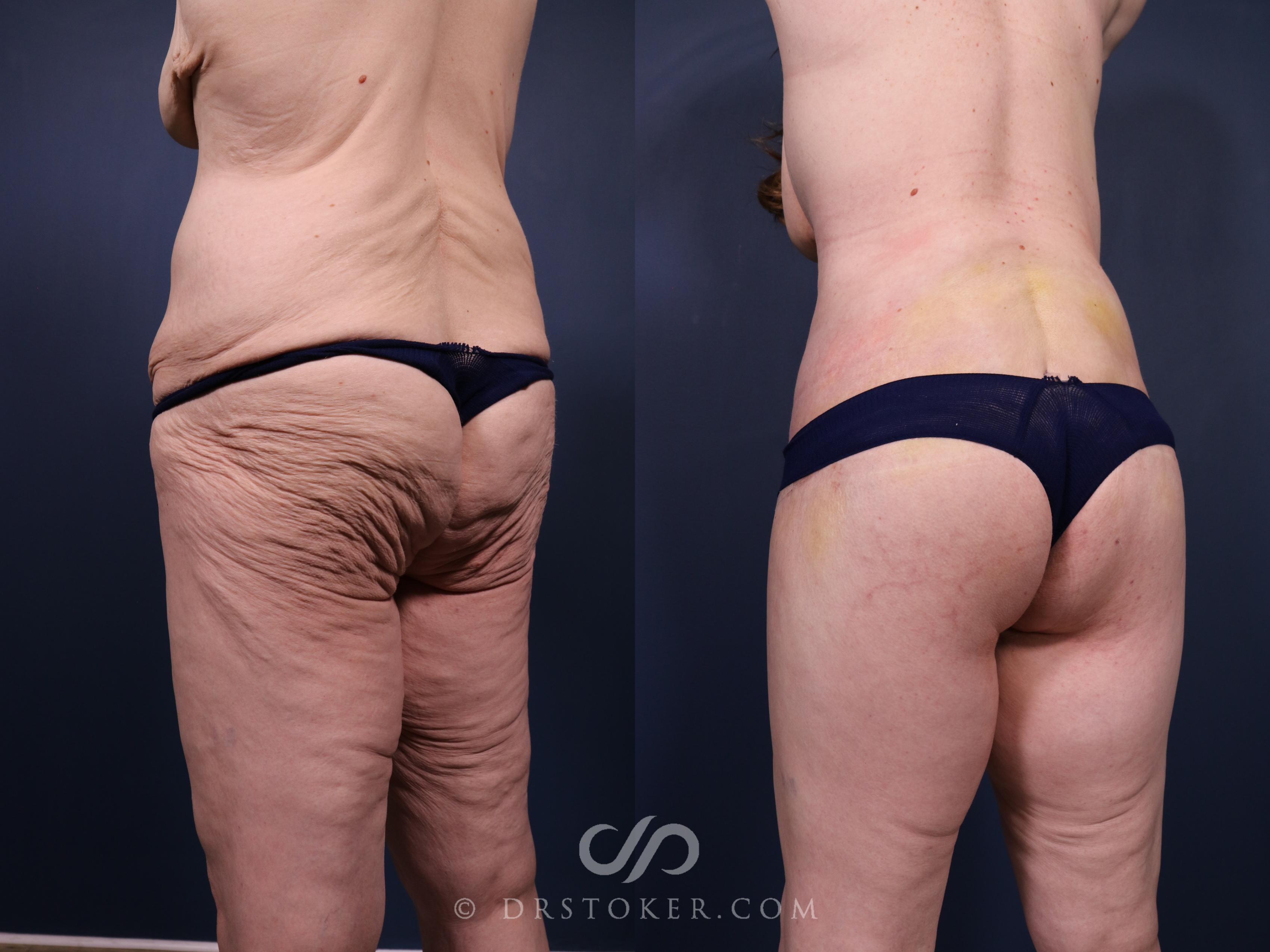 Before & After Buttock Lift (Excisional) Case 2398 Left Oblique View in Los Angeles, CA