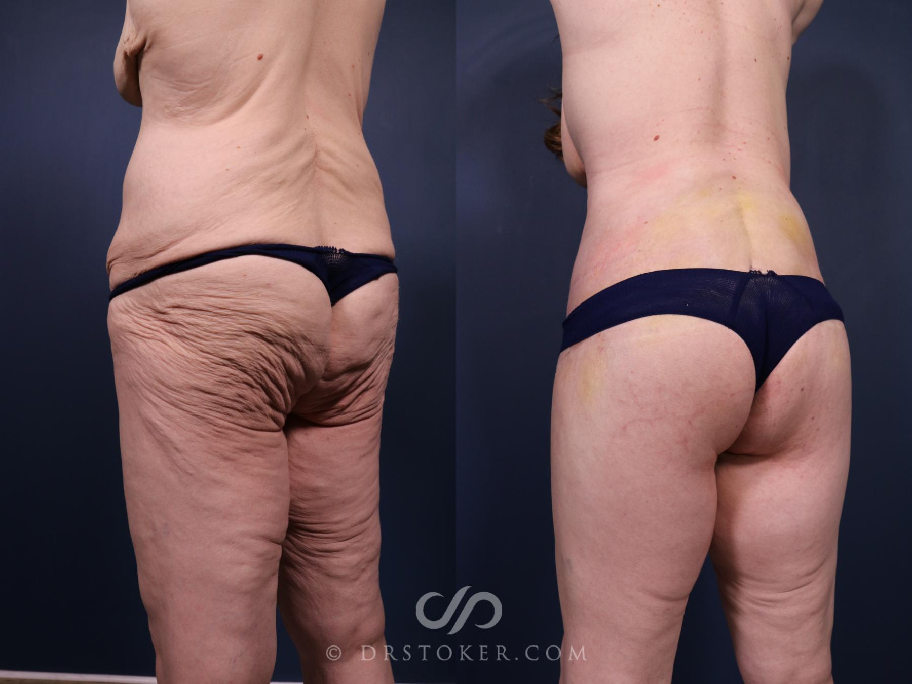 Before & After Buttock Lift (Excisional) Case 2398 Left Oblique View in Los Angeles, CA