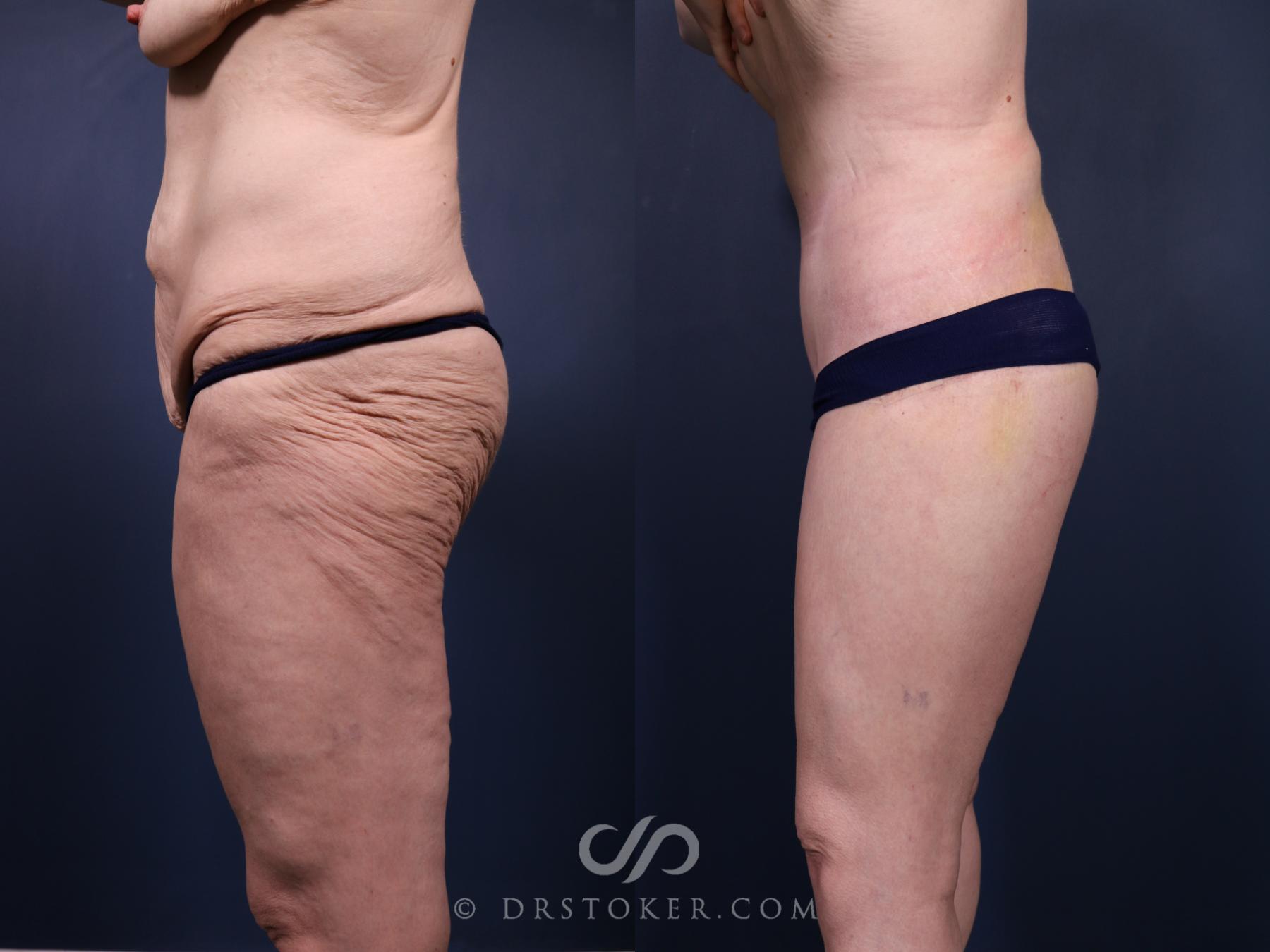 Before & After Buttock Lift (Excisional) Case 2398 Left Side View in Los Angeles, CA