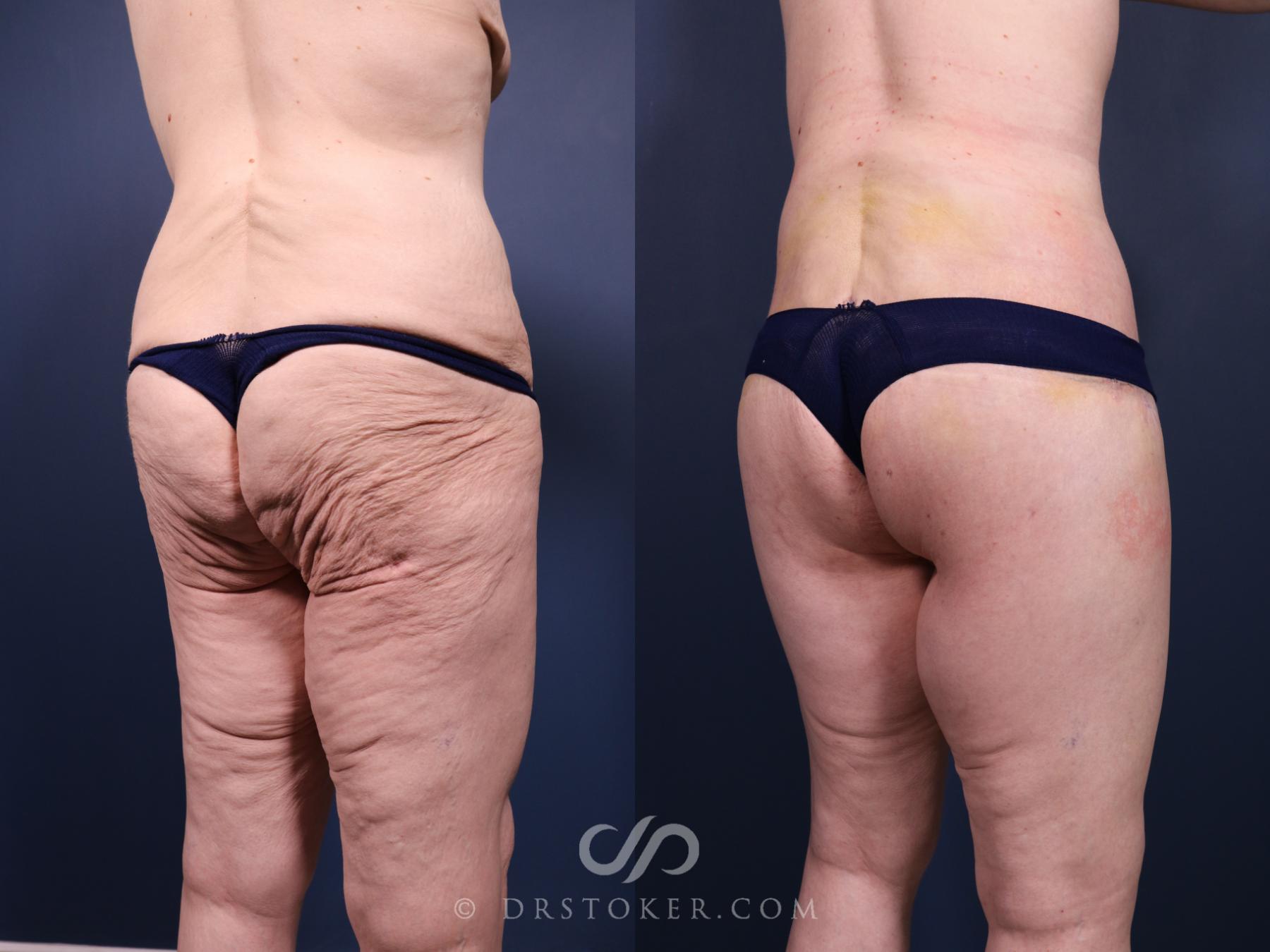 Before & After Buttock Lift (Excisional) Case 2398 Right Oblique View in Los Angeles, CA