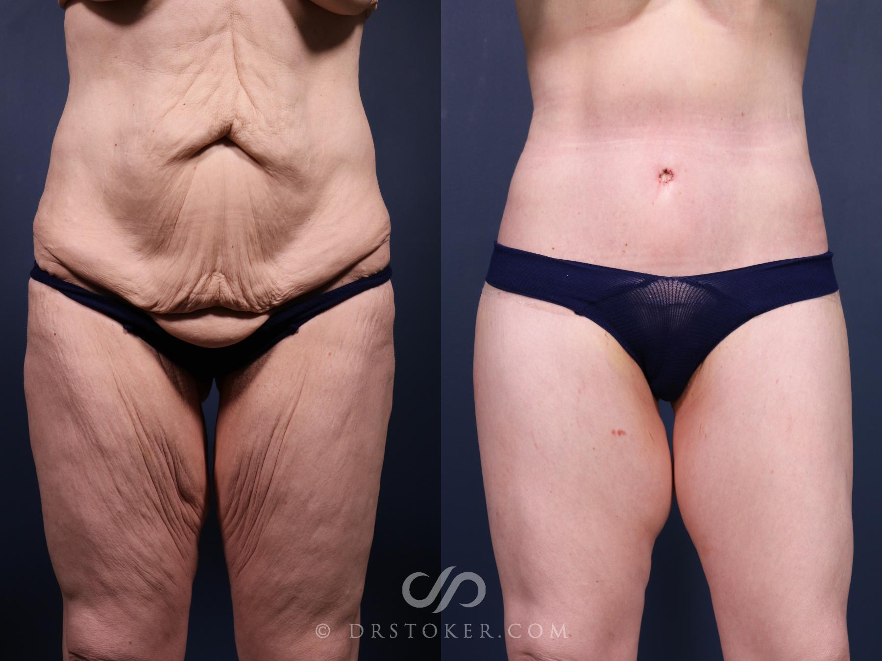 Before & After Bikini Body Lift Case 2399 Front View in Los Angeles, CA