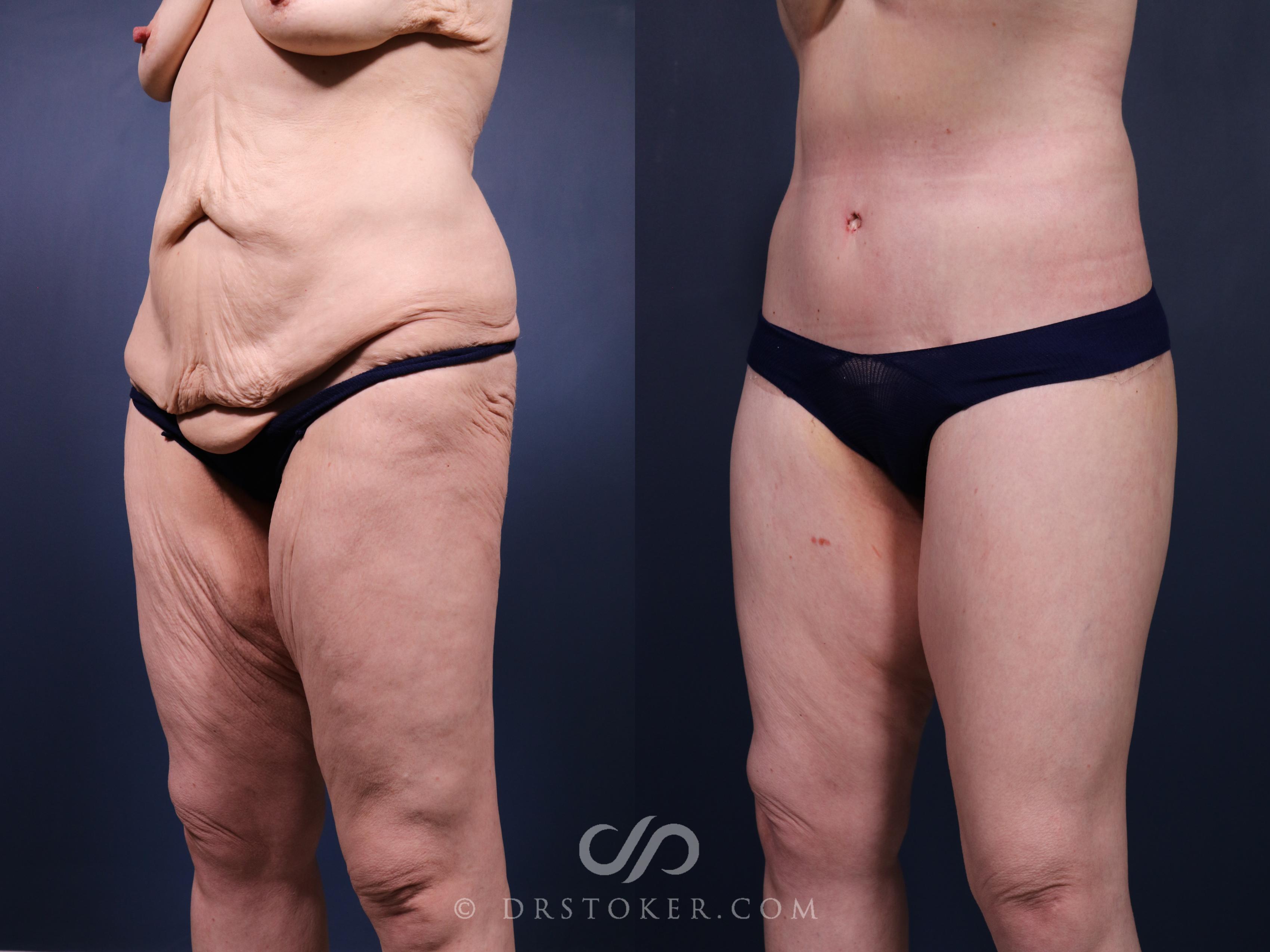Before & After Bikini Body Lift Case 2399 Left Oblique View in Los Angeles, CA