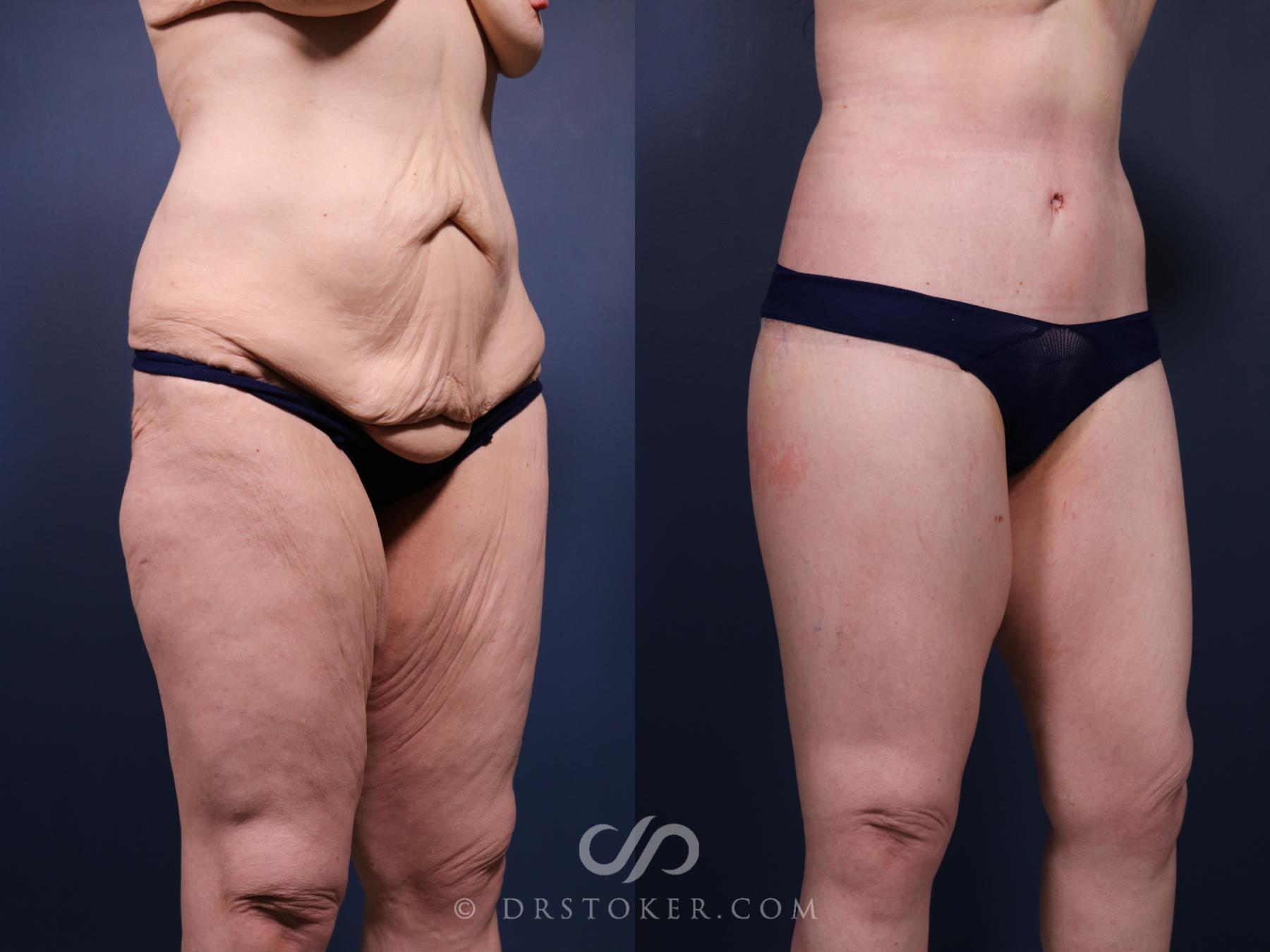 Before & After Bikini Body Lift Case 2399 Right Oblique View in Los Angeles, CA