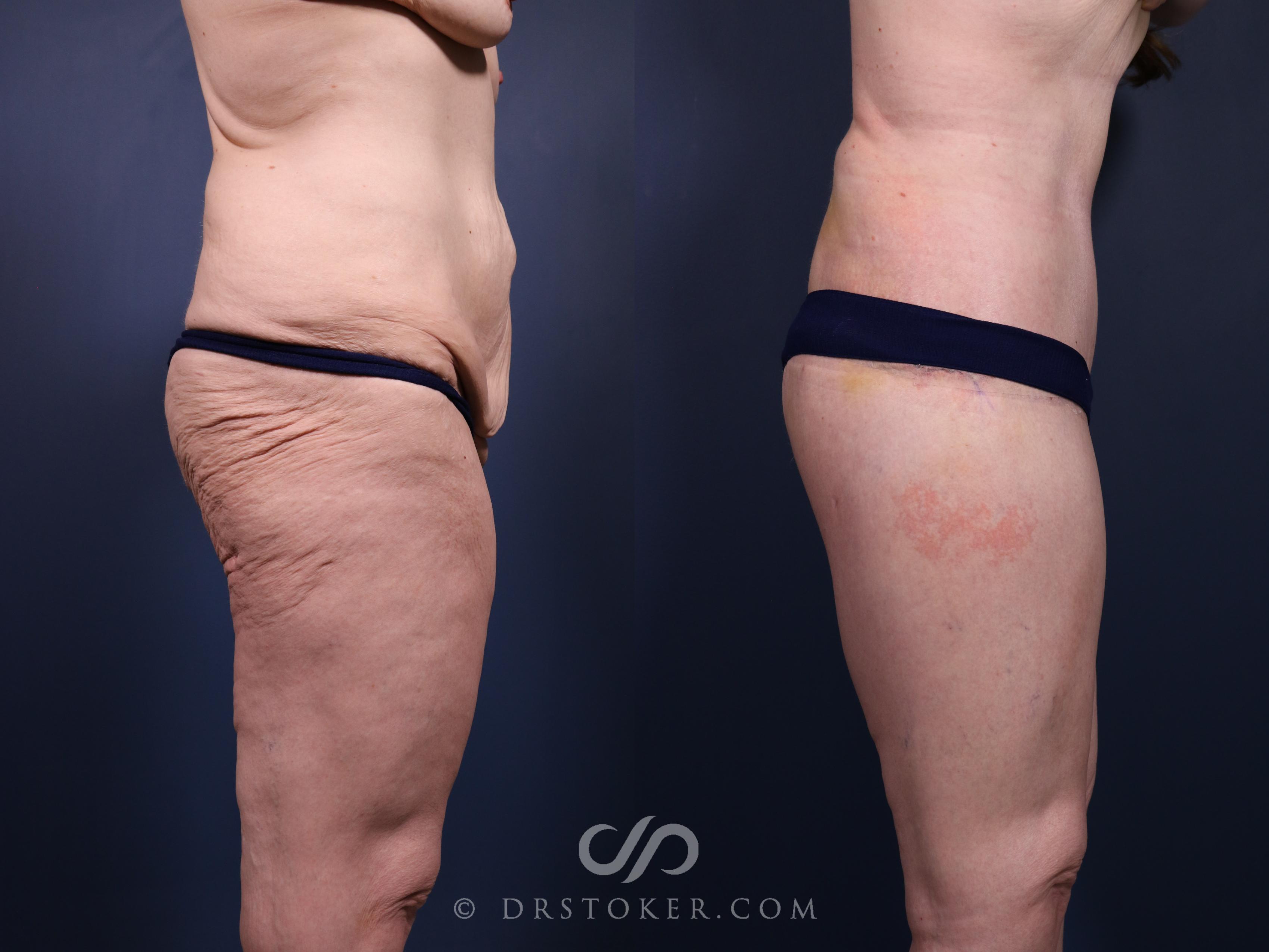 Before & After Bikini Body Lift Case 2399 Right Side View in Los Angeles, CA