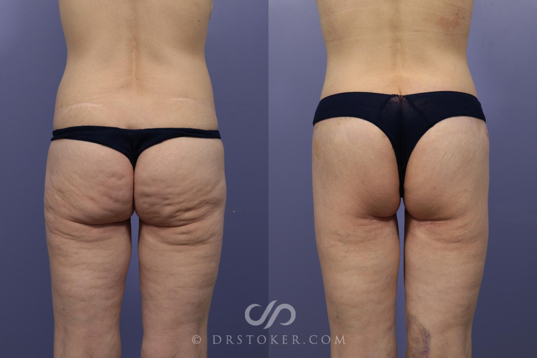 Before & After Bikini Body Lift Case 2400 Back View in Los Angeles, CA