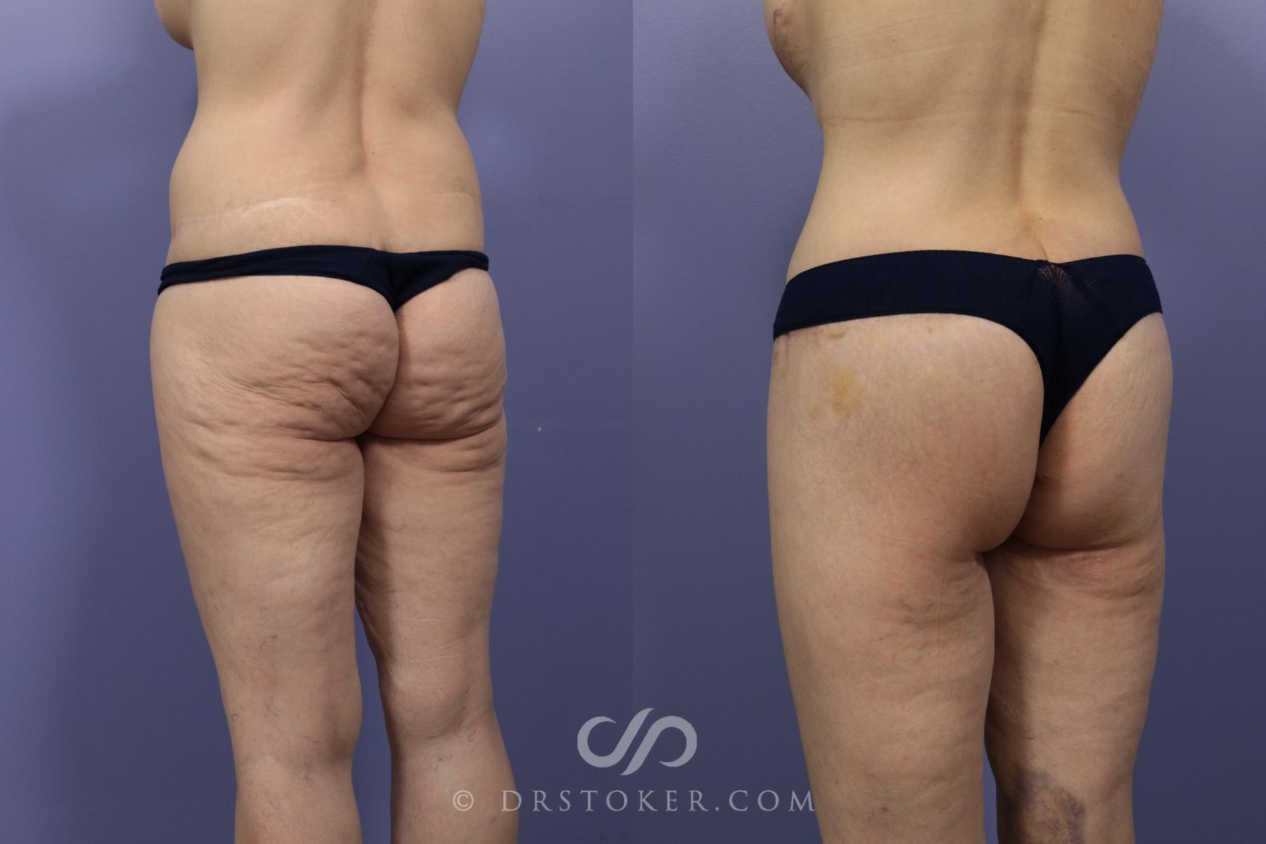 Before & After Bikini Body Lift Case 2400 Left Oblique View in Los Angeles, CA