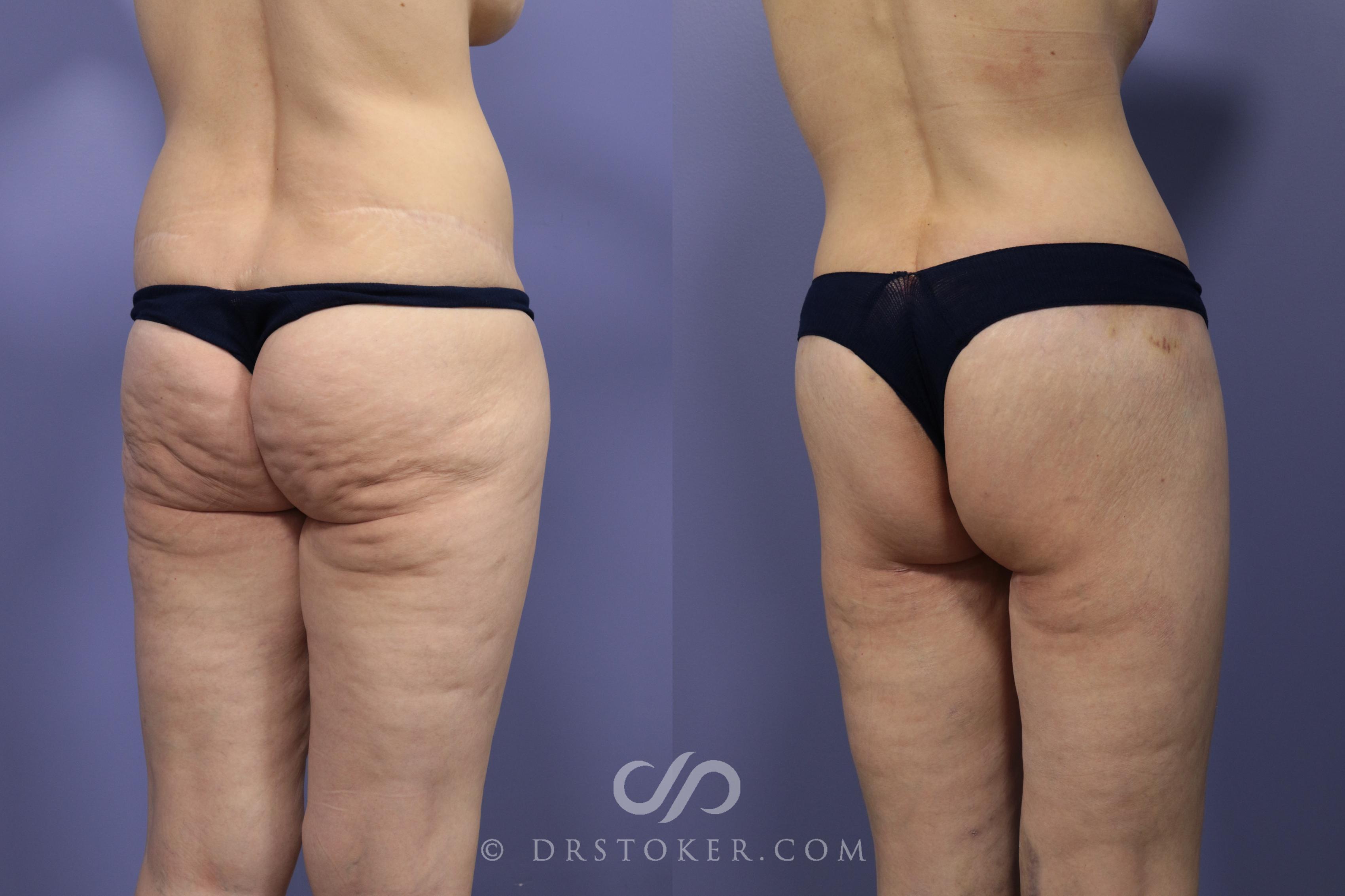 Before & After Bikini Body Lift Case 2400 Right Oblique View in Los Angeles, CA