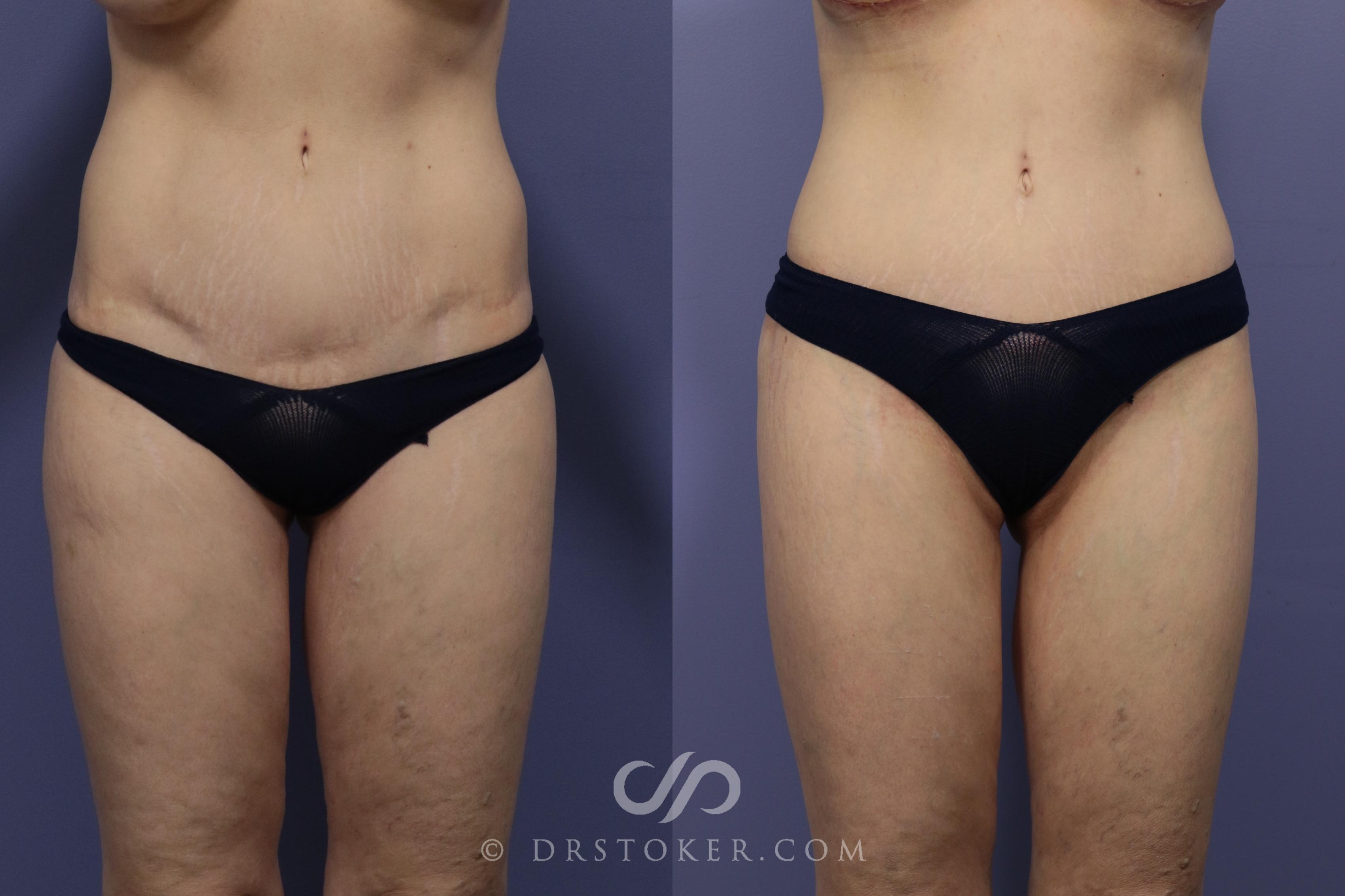 Before & After Bikini Body Lift Case 2401 Front View in Los Angeles, CA