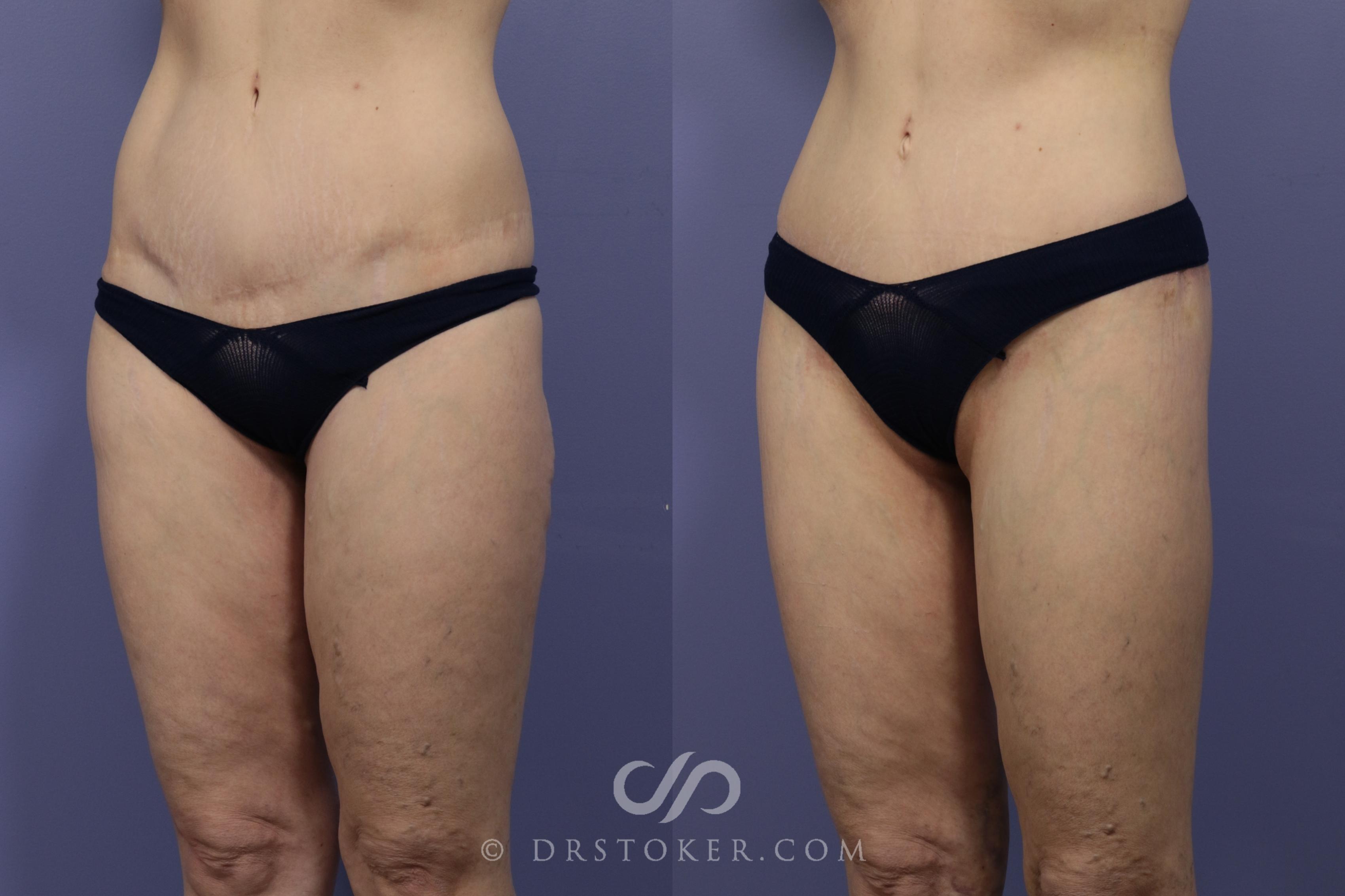 Before & After Bikini Body Lift Case 2401 Left Oblique View in Los Angeles, CA