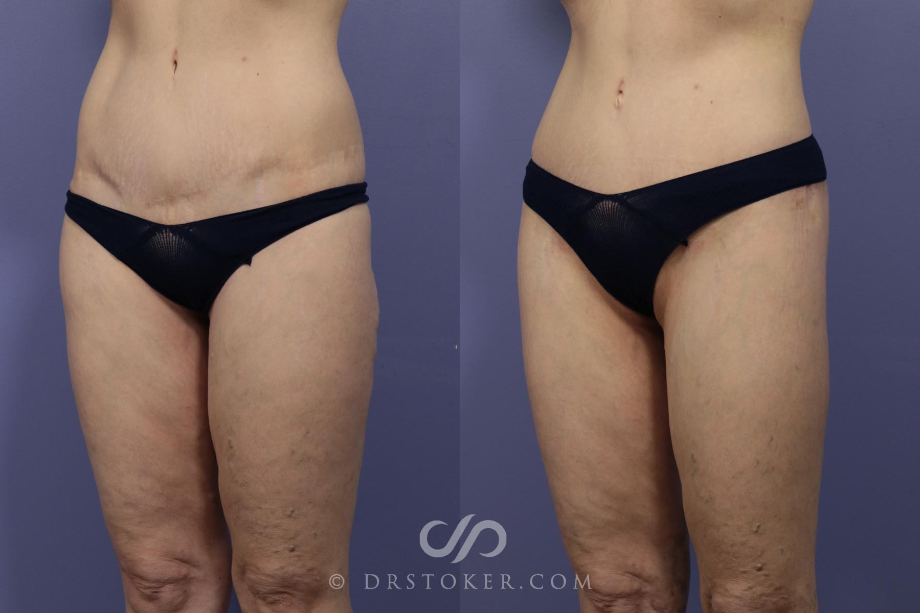 Before & After Bikini Body Lift Case 2401 Left Oblique View in Los Angeles, CA