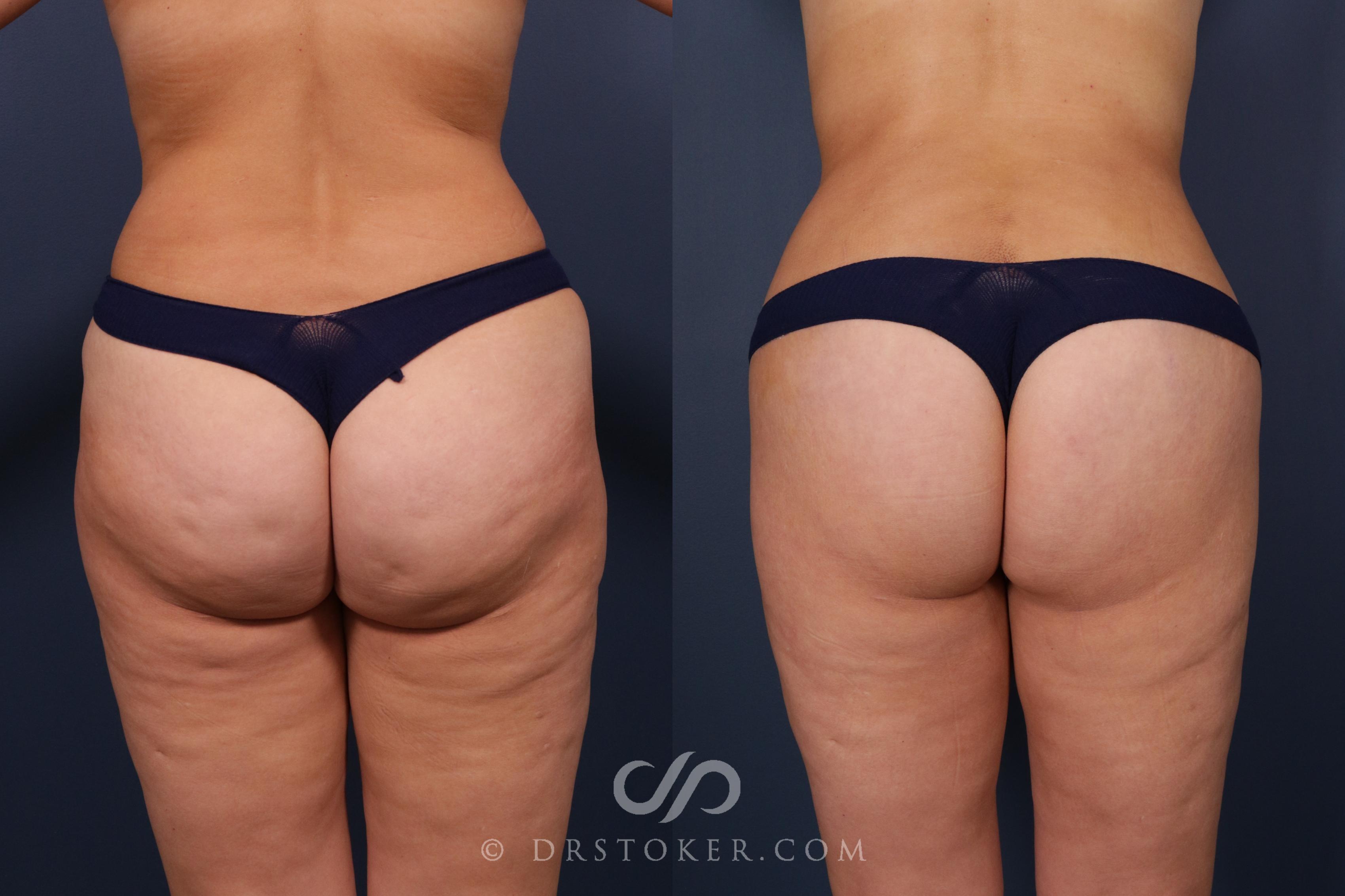 Before & After Bikini Body Lift Case 2402 Back View in Los Angeles, CA