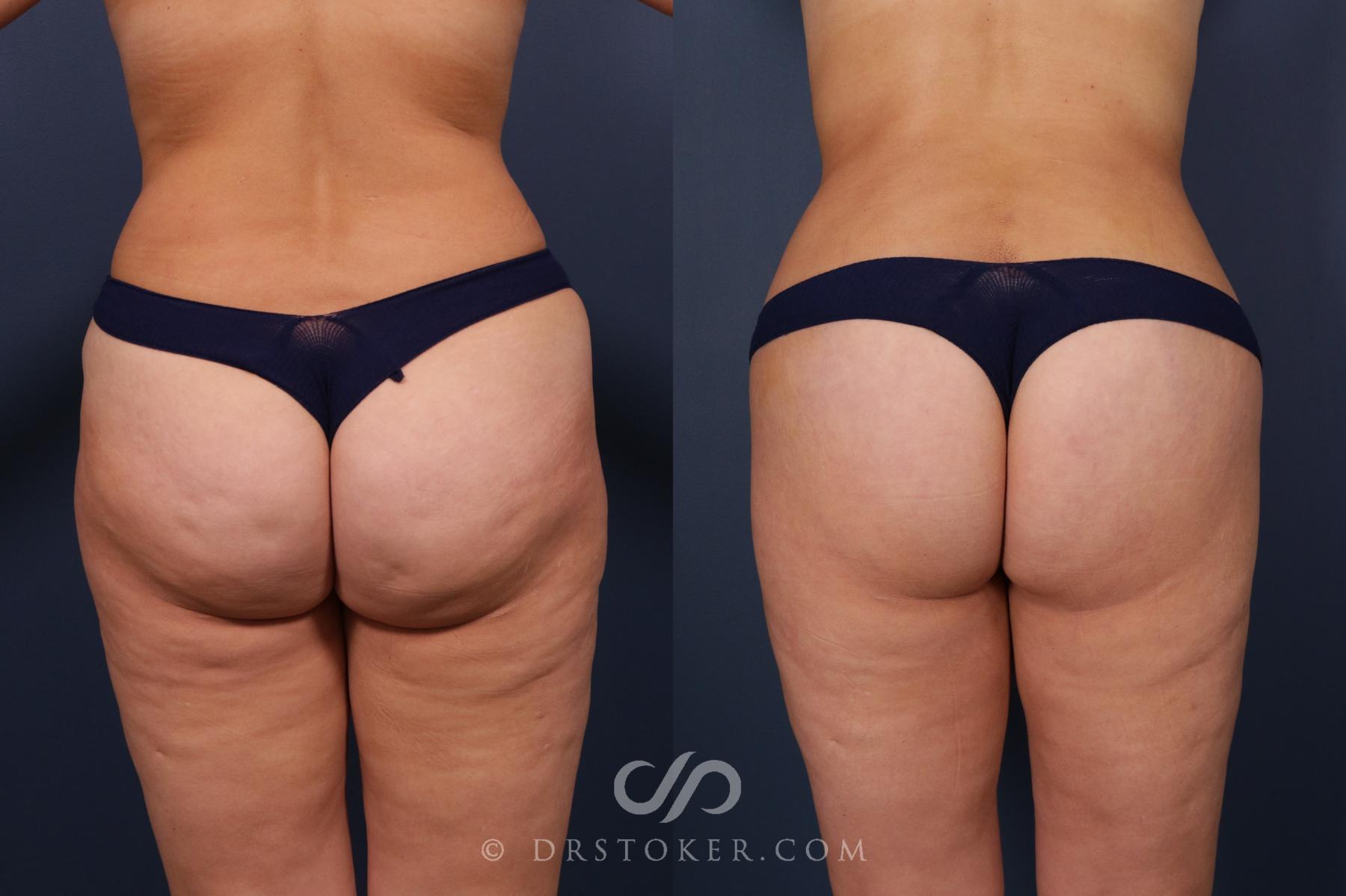 Before & After Bikini Body Lift Case 2402 Back View in Los Angeles, CA