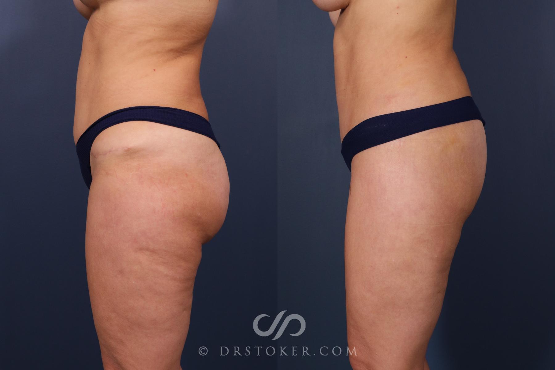Before & After Bikini Body Lift Case 2402 Left Side View in Los Angeles, CA