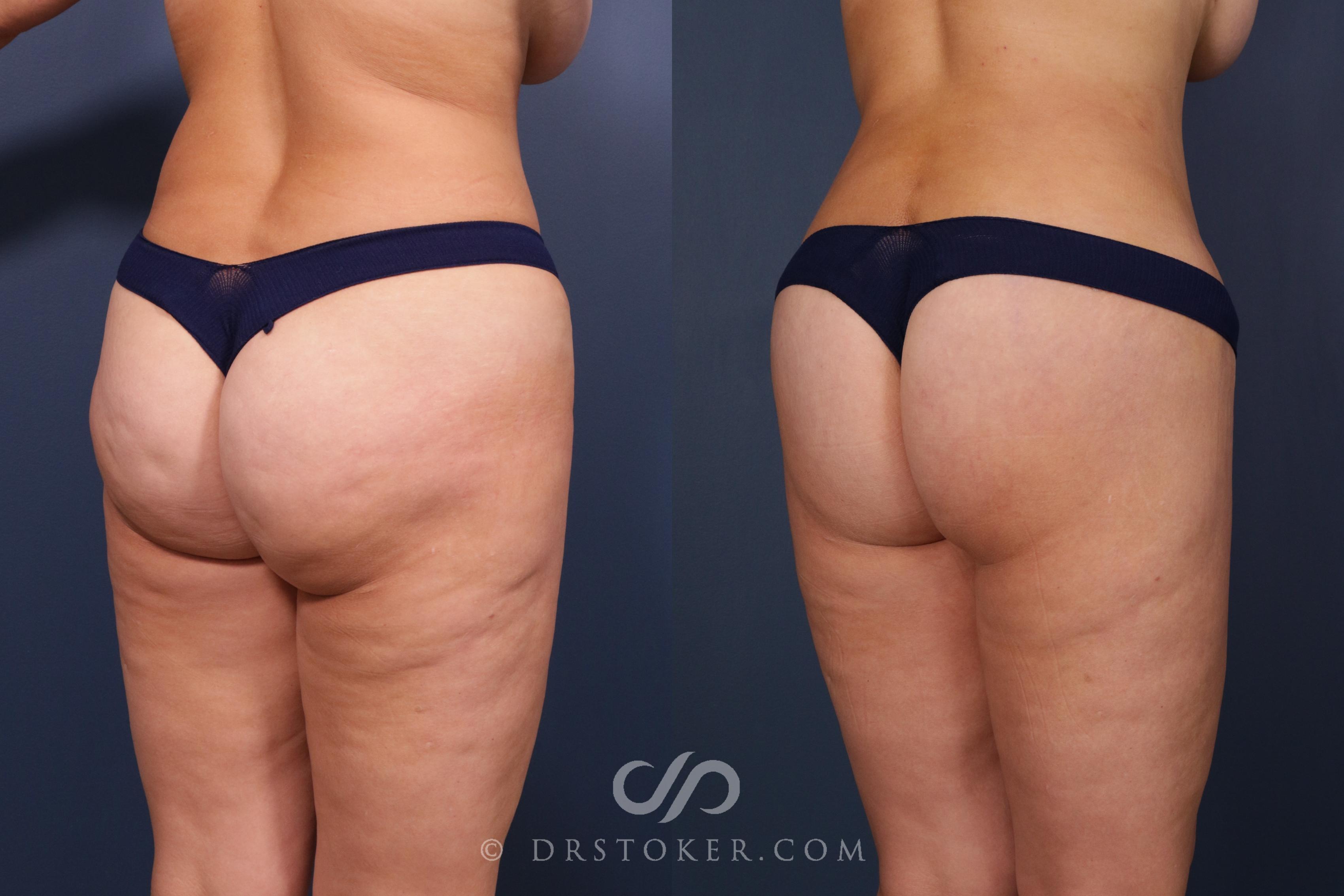 Before & After Bikini Body Lift Case 2402 Right Oblique View in Los Angeles, CA