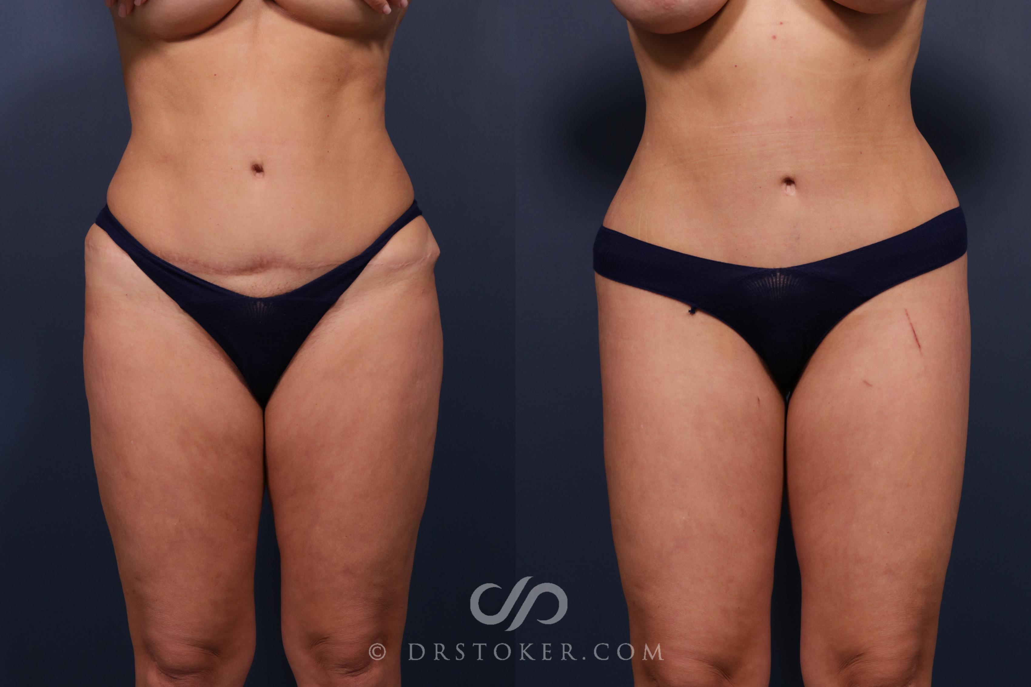 Before & After Bikini Body Lift Case 2403 Front View in Los Angeles, CA