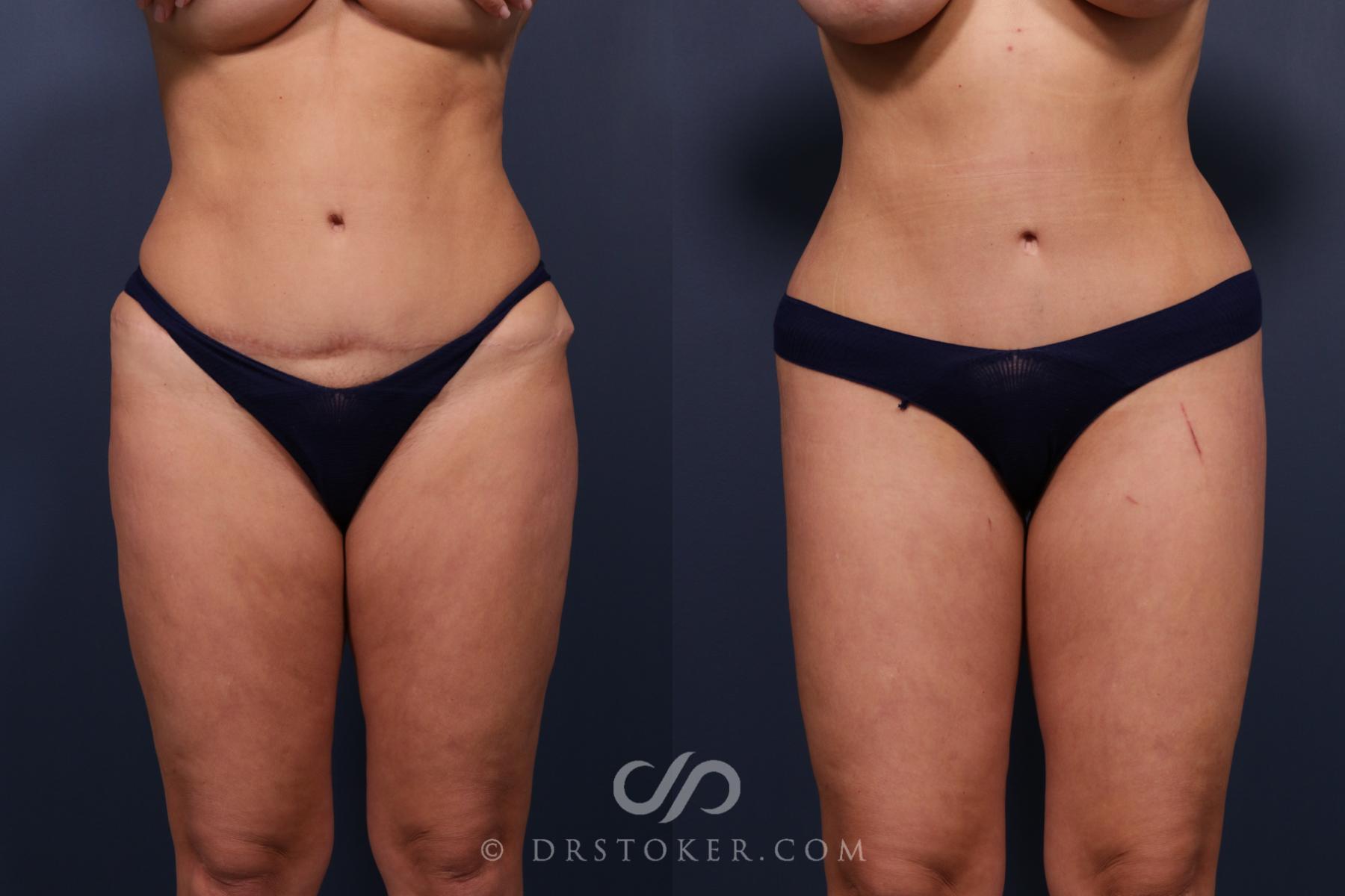 Before & After Bikini Body Lift Case 2403 Front View in Los Angeles, CA