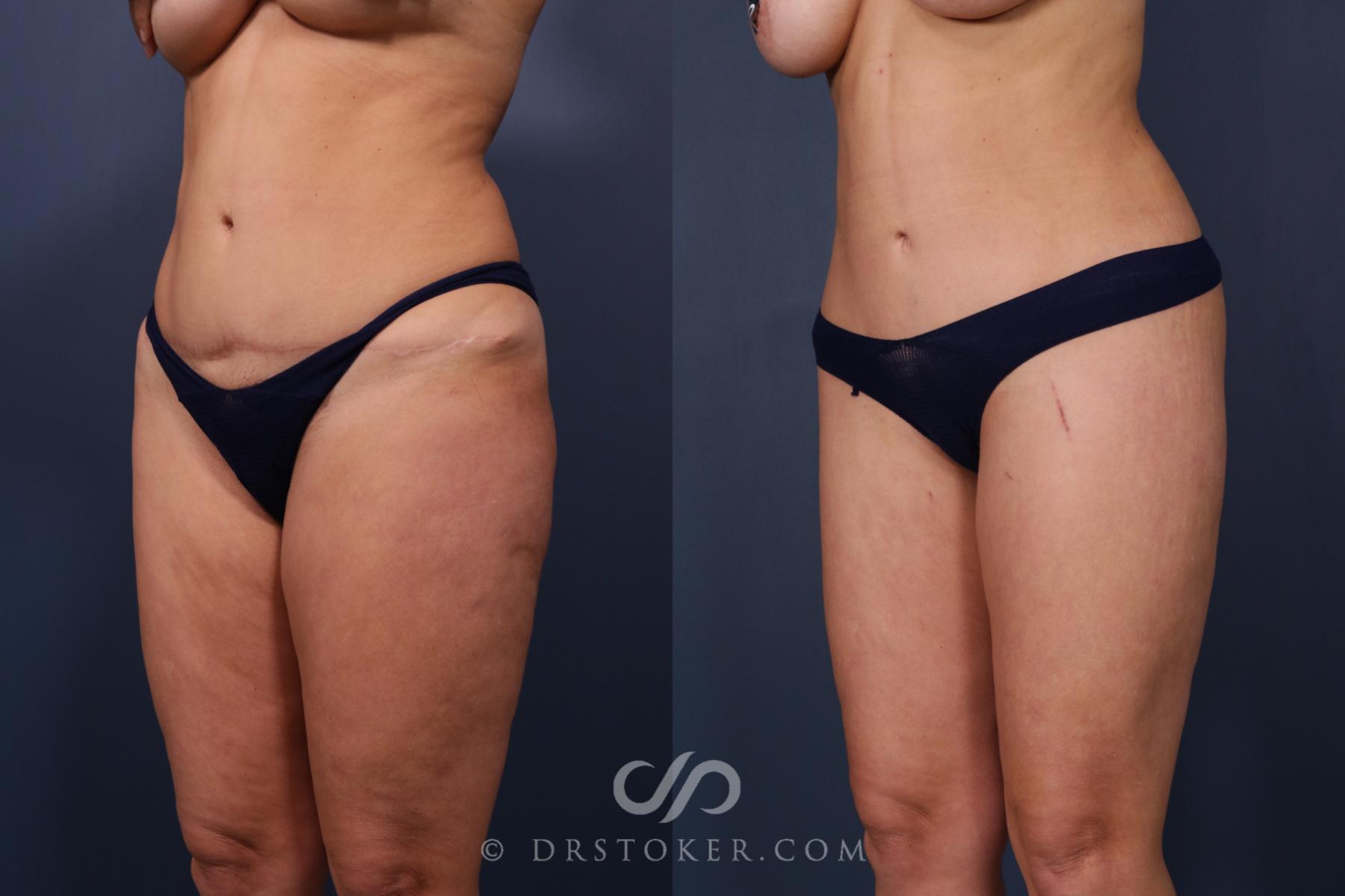 Before & After Bikini Body Lift Case 2403 Left Oblique View in Los Angeles, CA