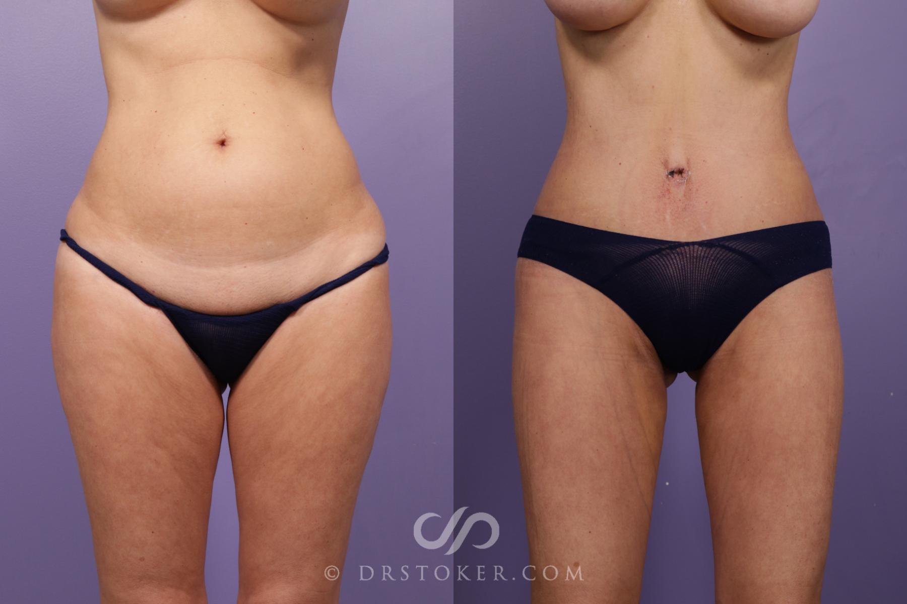 Before & After Bikini Body Lift Case 2404 Front View in Los Angeles, CA