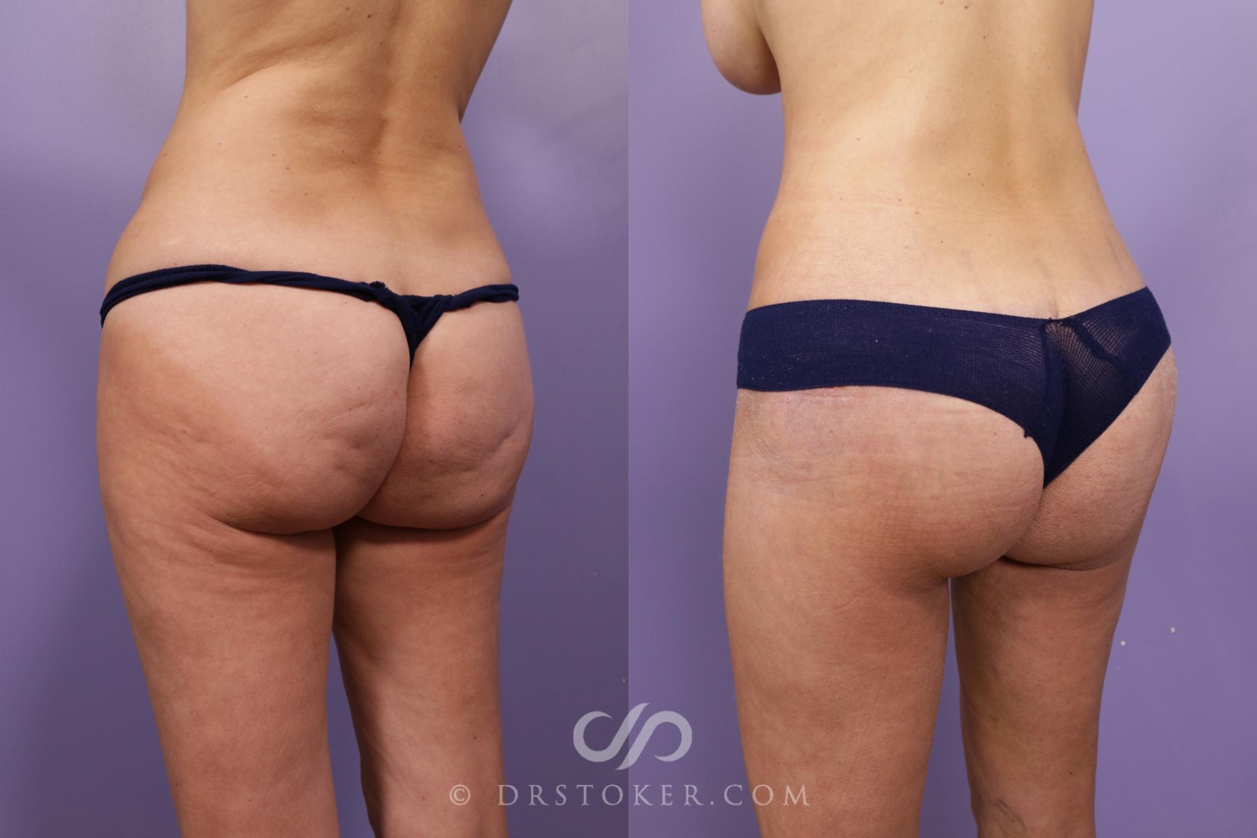 Before & After Bikini Body Lift Case 2404 Left Oblique View in Los Angeles, CA