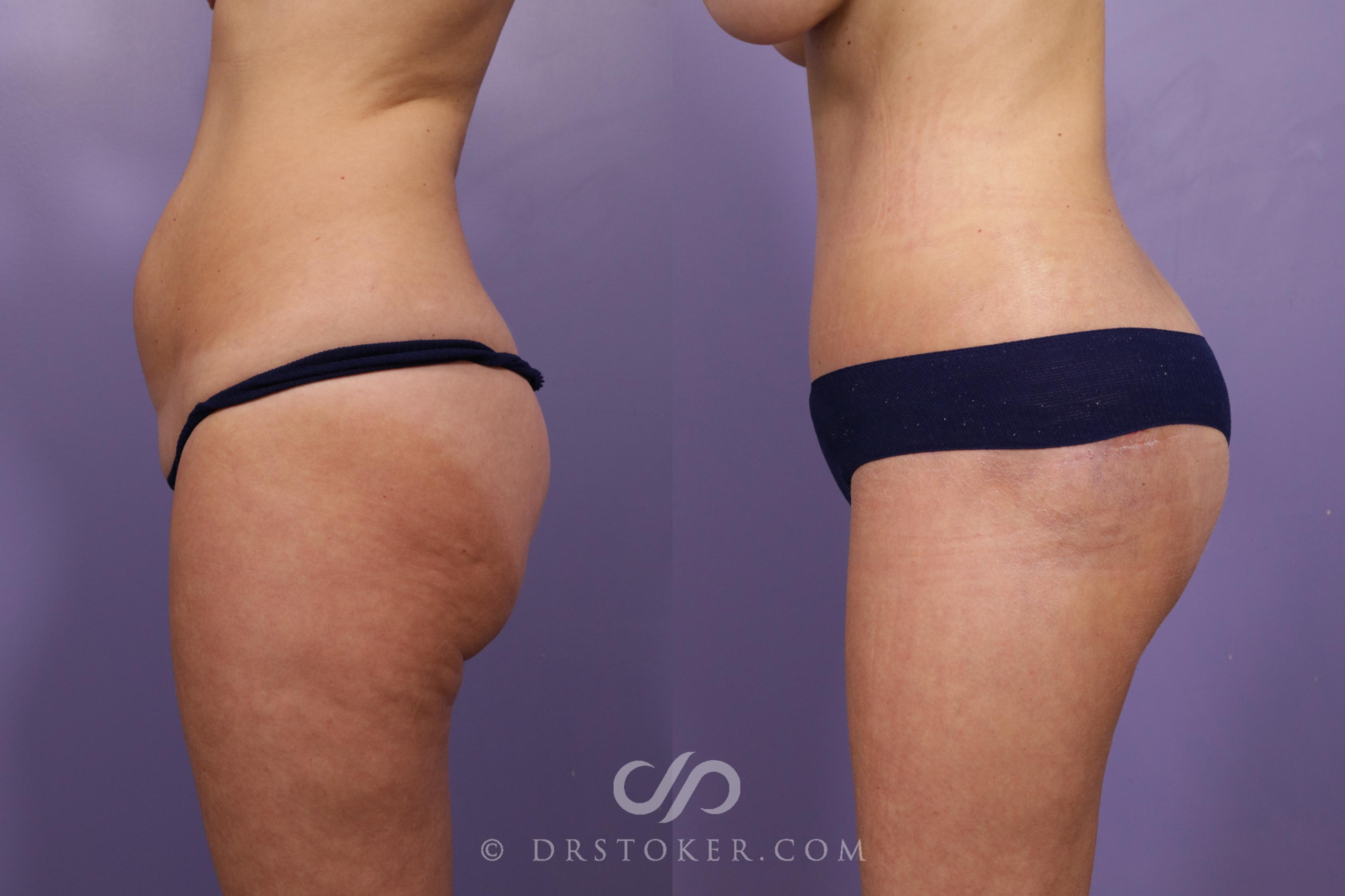 Before & After Bikini Body Lift Case 2404 Left Side View in Los Angeles, CA