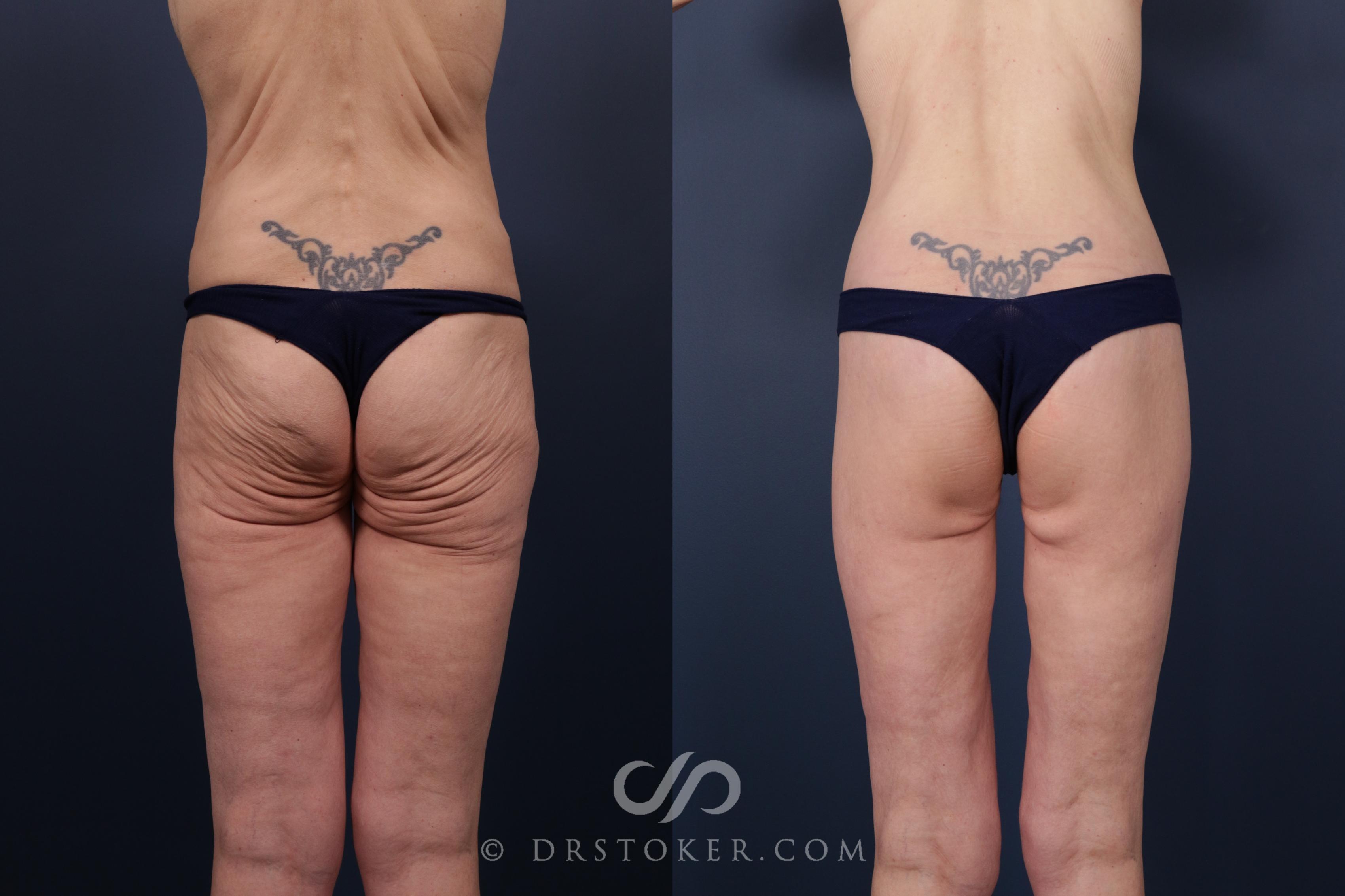 Before & After Bikini Body Lift Case 2405 Back View in Los Angeles, CA