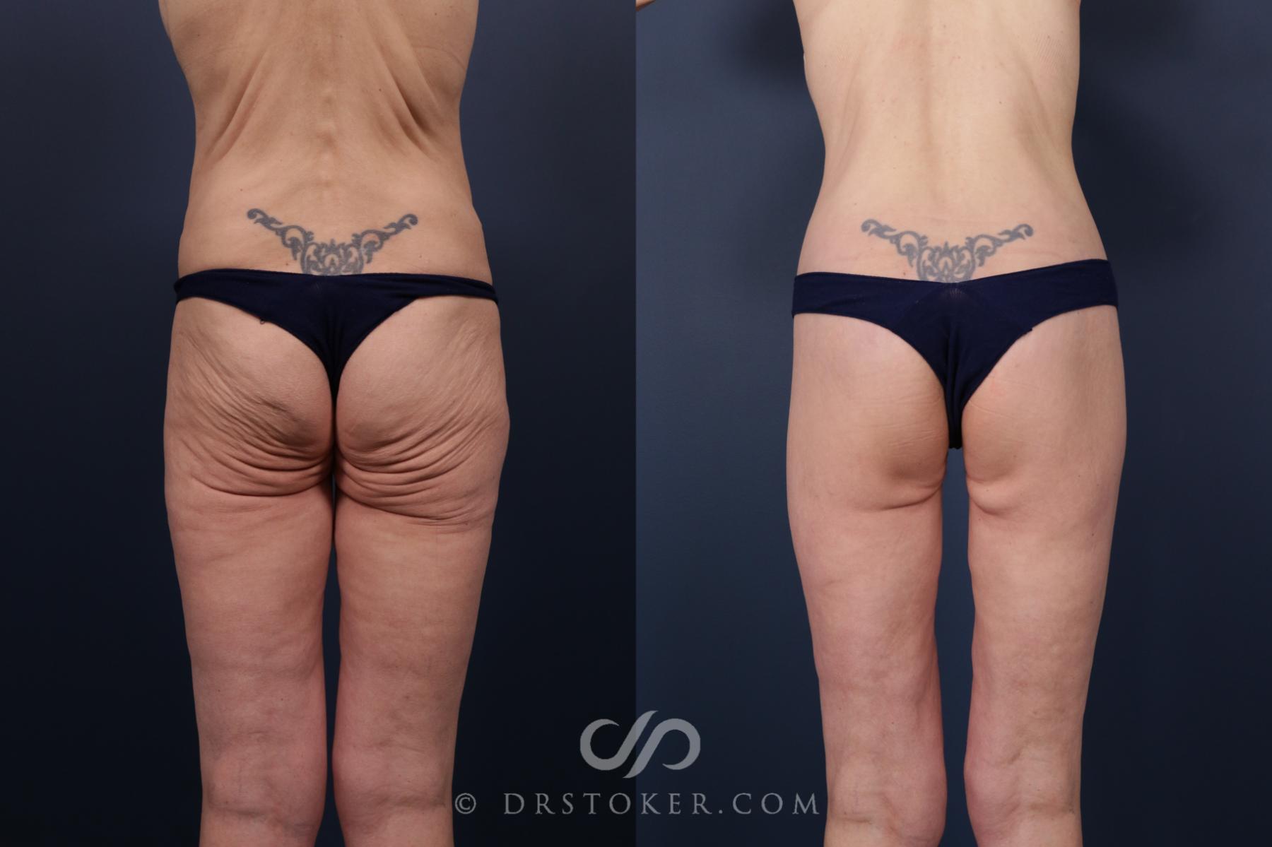 Before & After Bikini Body Lift Case 2405 Back View in Los Angeles, CA